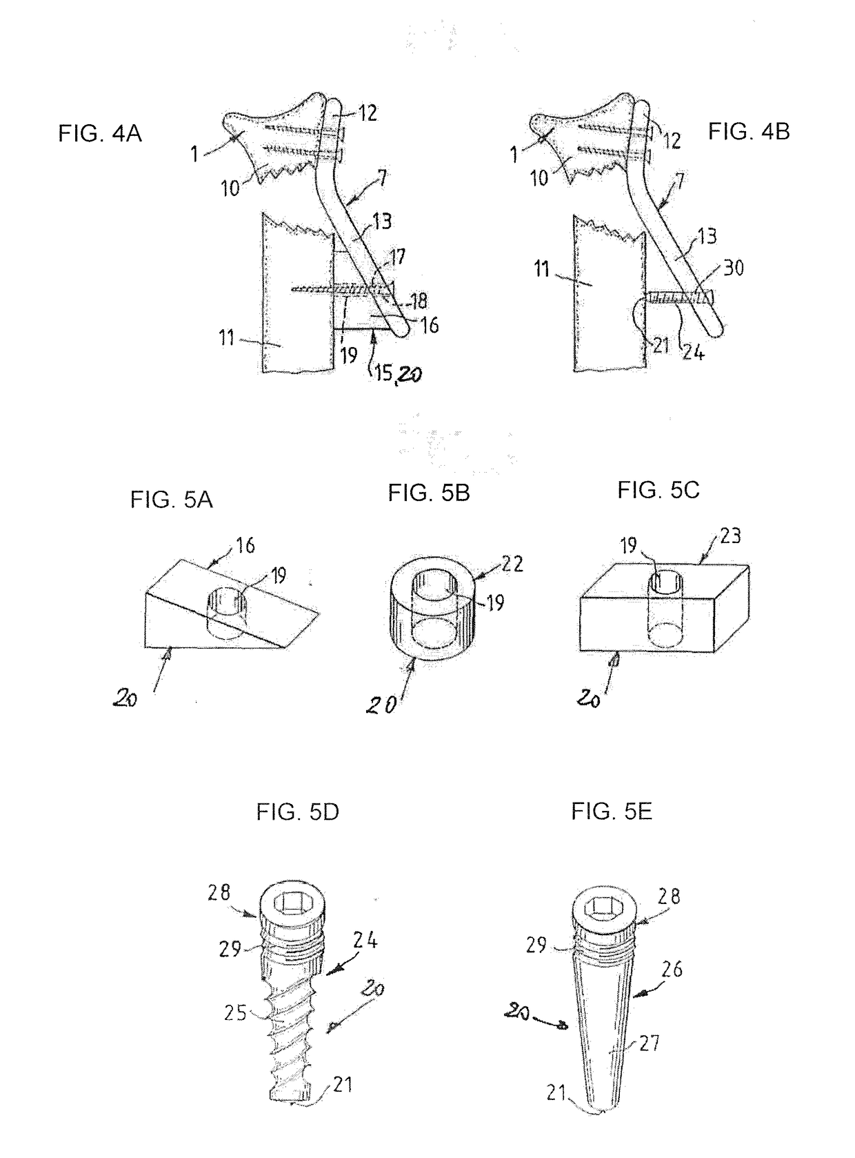 Method of treating a distal radius fracture