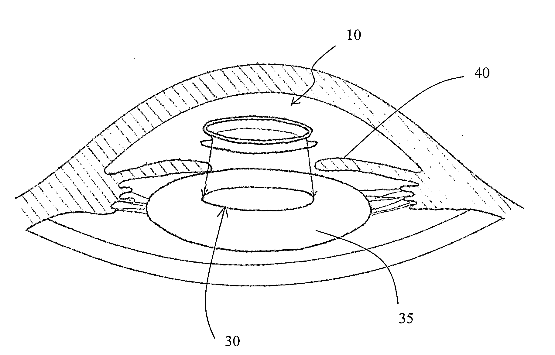 Capsular Implant For Maintaining The shape and/or Position of an Opening Formed by Capsulorhexis