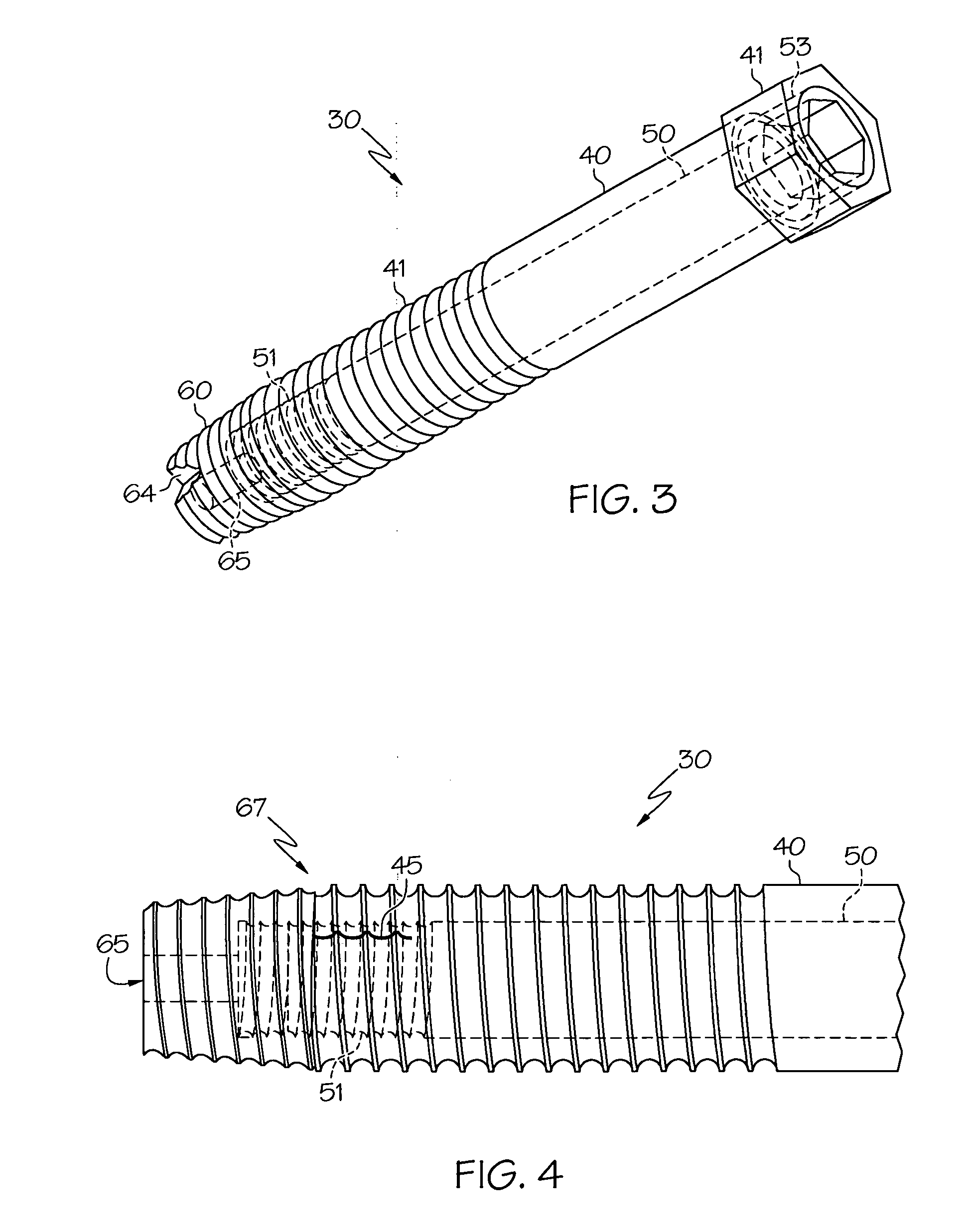 Spinal facet fixation device