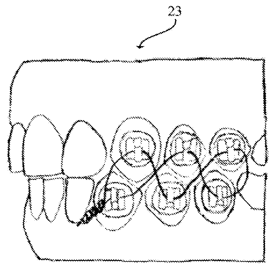Orthodontic Jaw Wiring, a fixed intra-oral device and method to limit jaw opening, thereby preventing ingestion of solid food