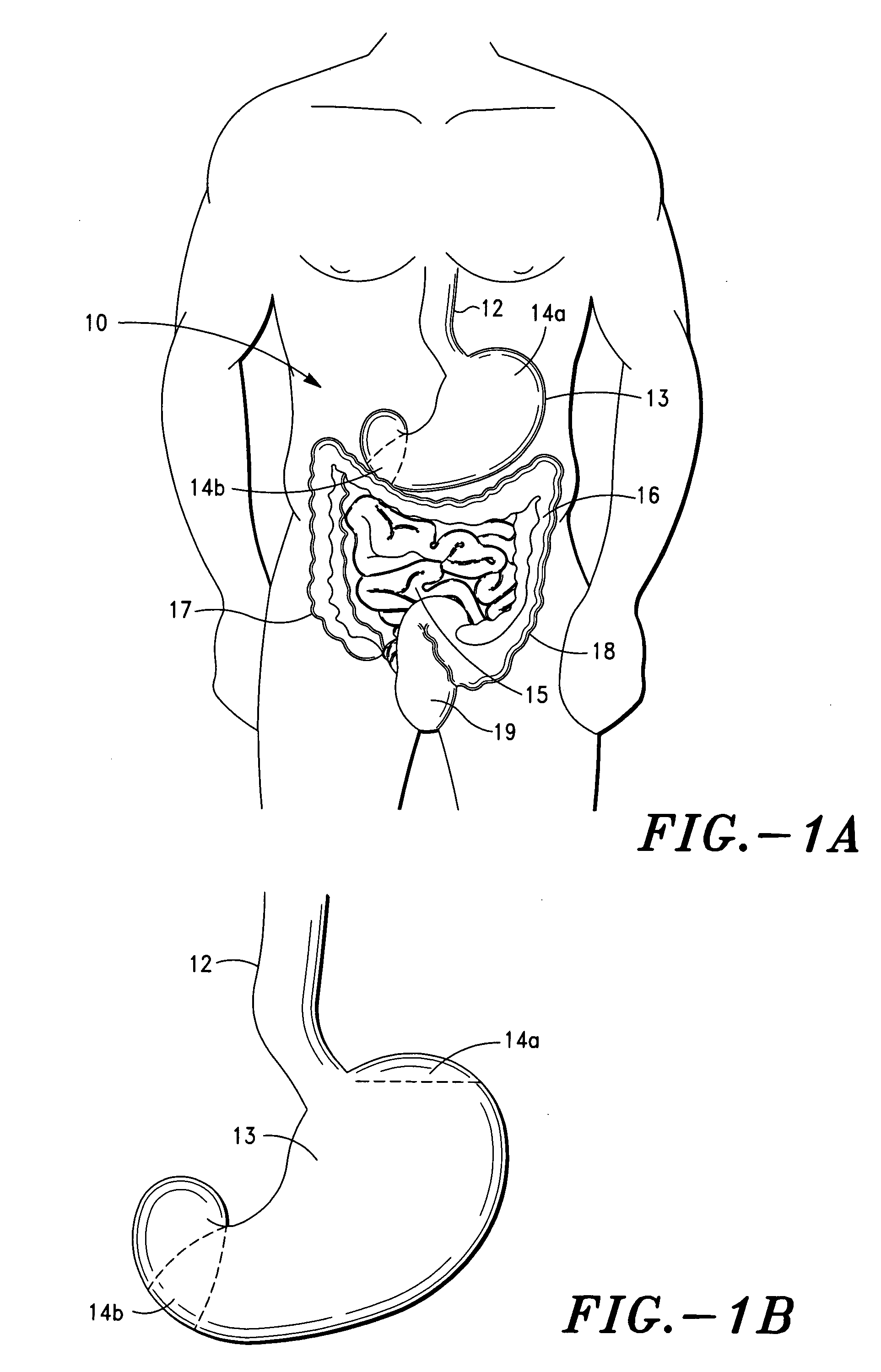 Gastric restriction method and system for treatment of eating disorders