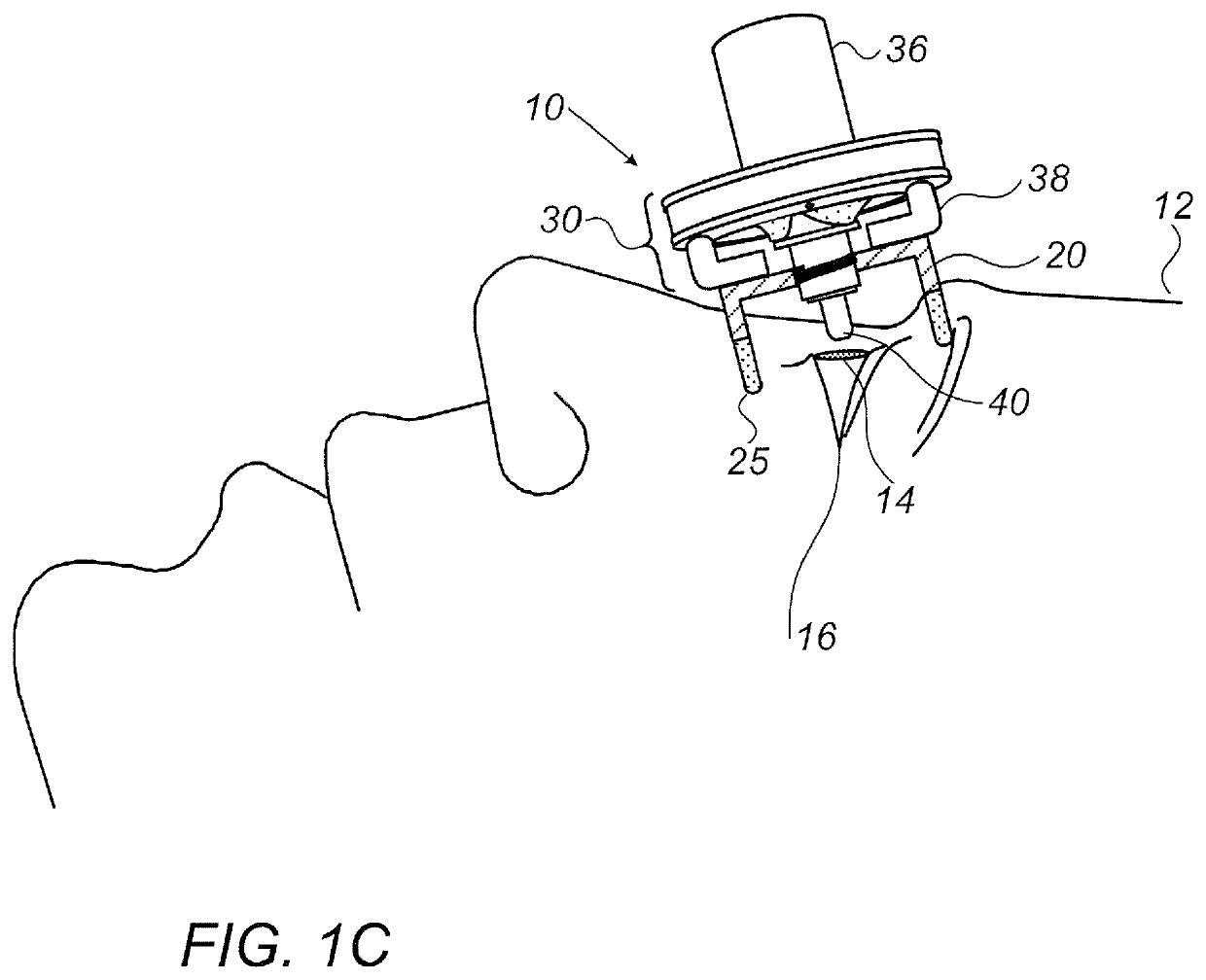 Eye drop guide device for instilling eye drops