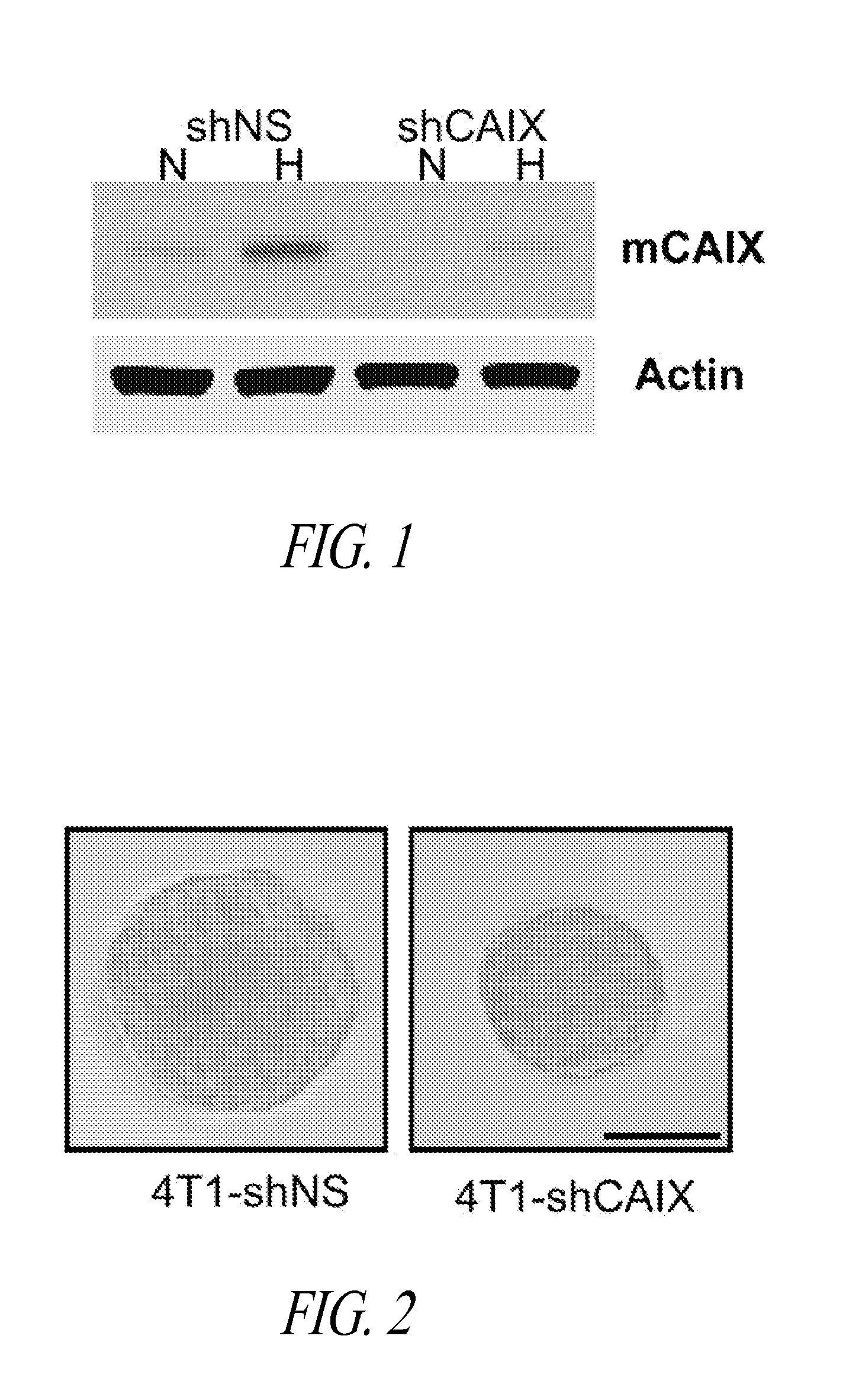 Carbonic anhydrase ix-related markers and use thereof