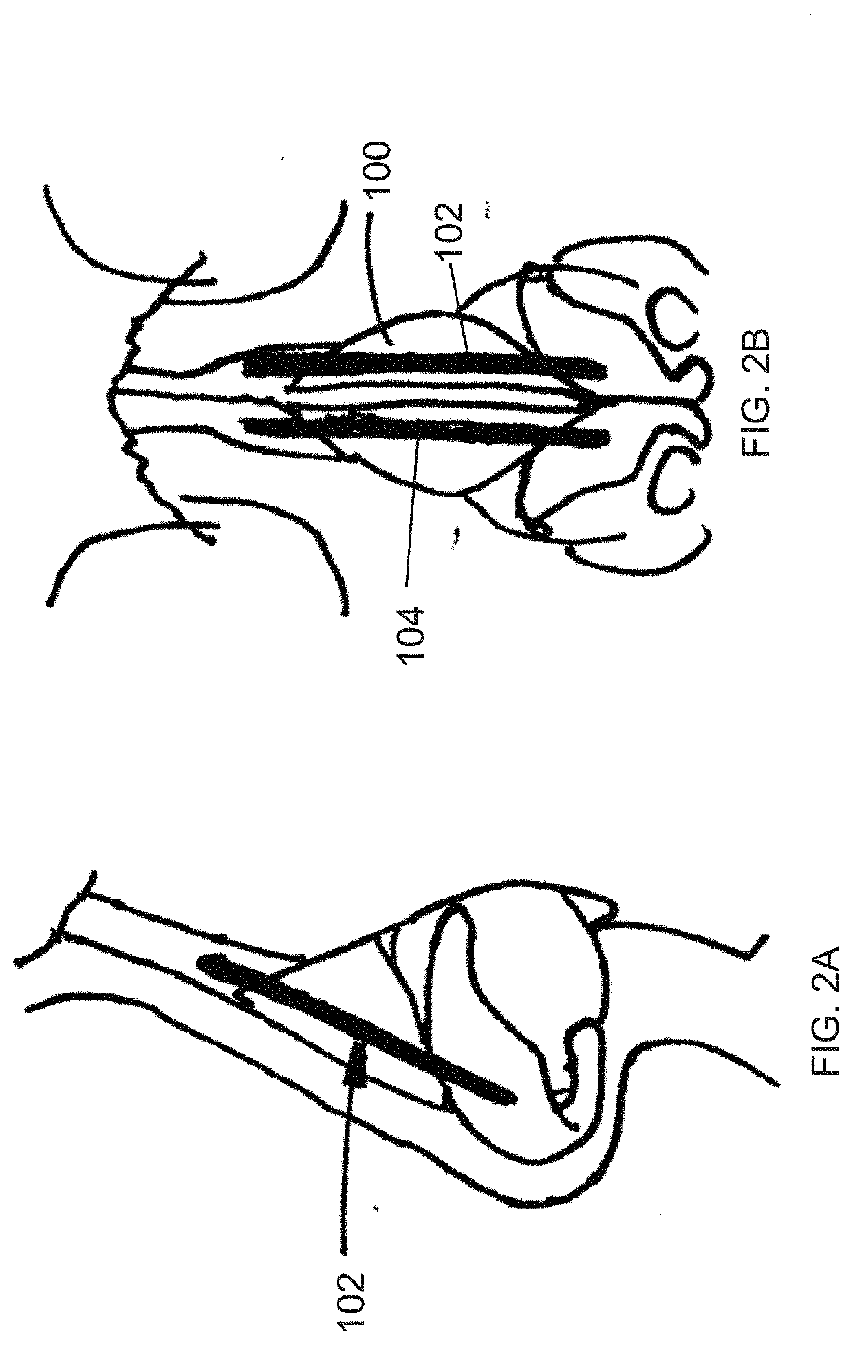 Systems and methods for nasal support