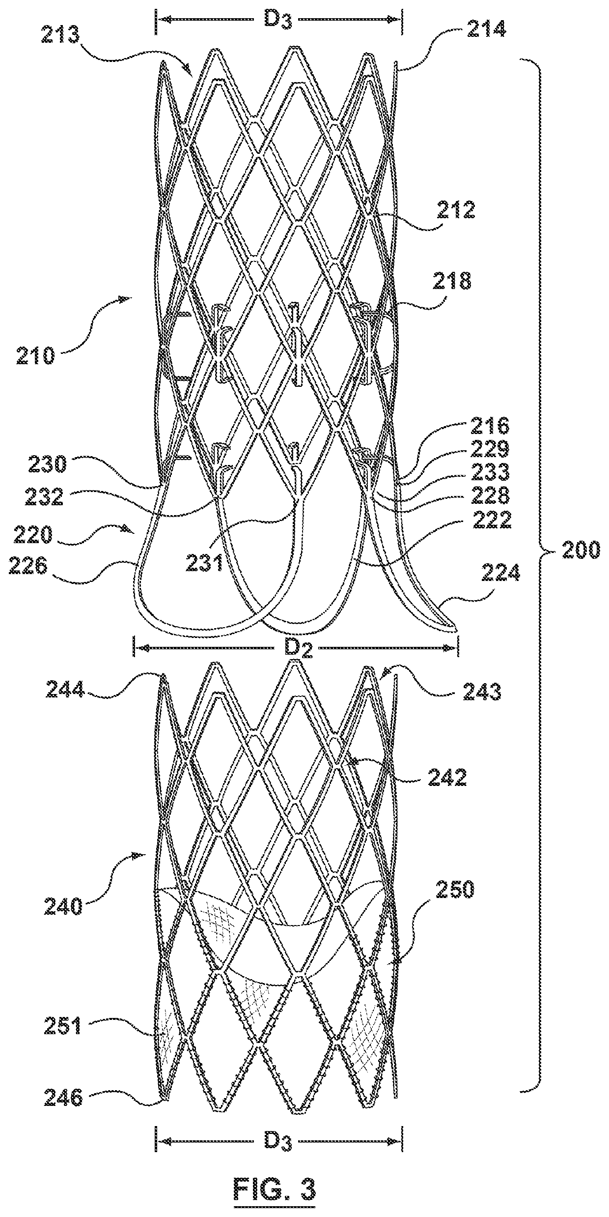 Two-piece valve prosthesis with anchor stent and valve component