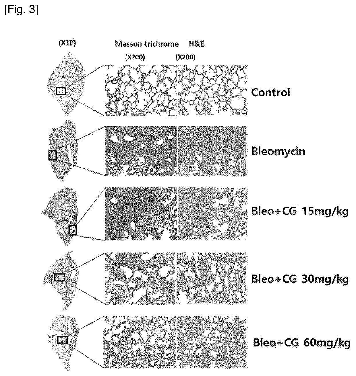 Pharmaceutical composition for prevention or treatment of fibrosis