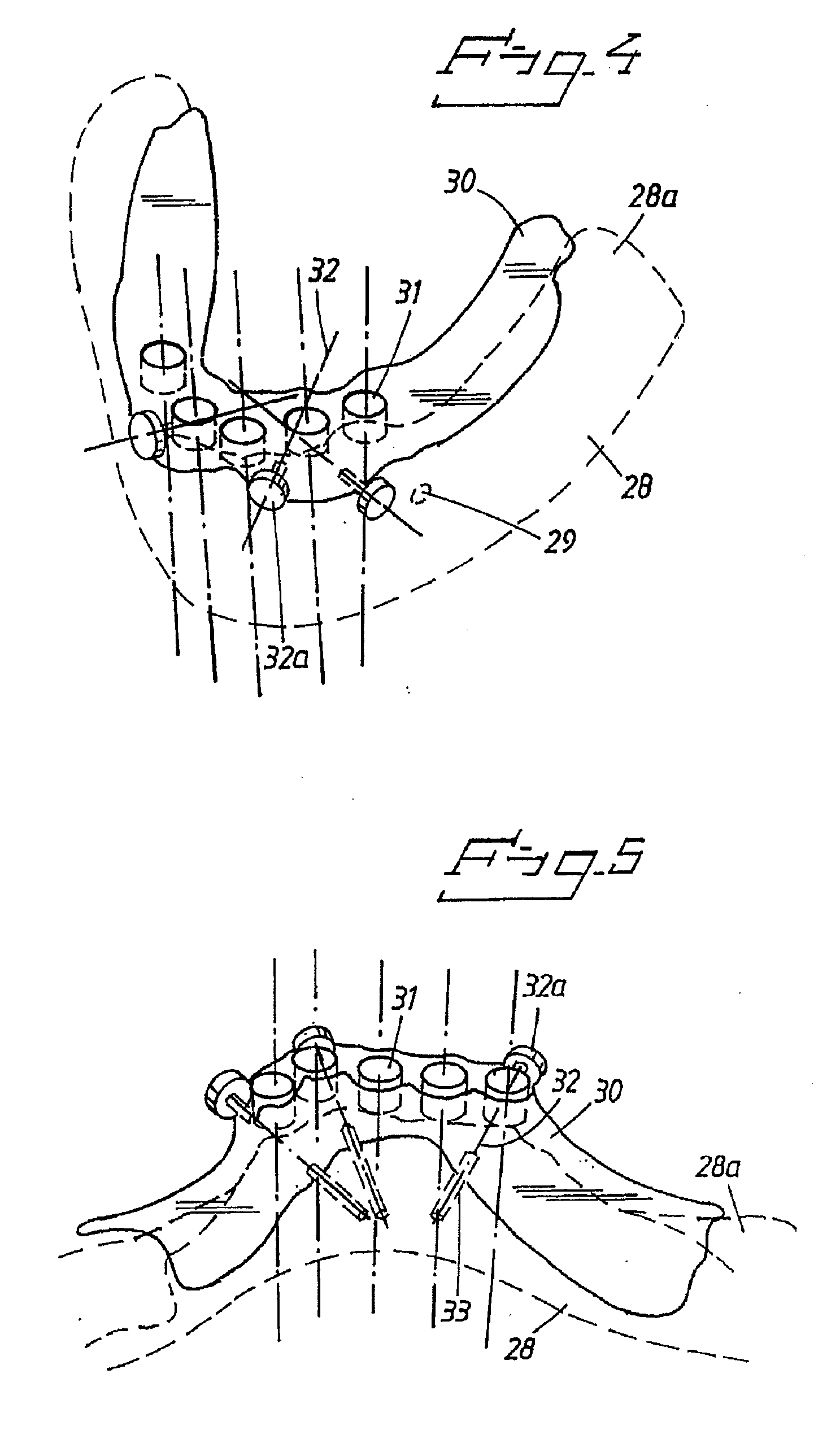 Arrangement and device for using a template to form holes for implants in bone, preferably jaw bone