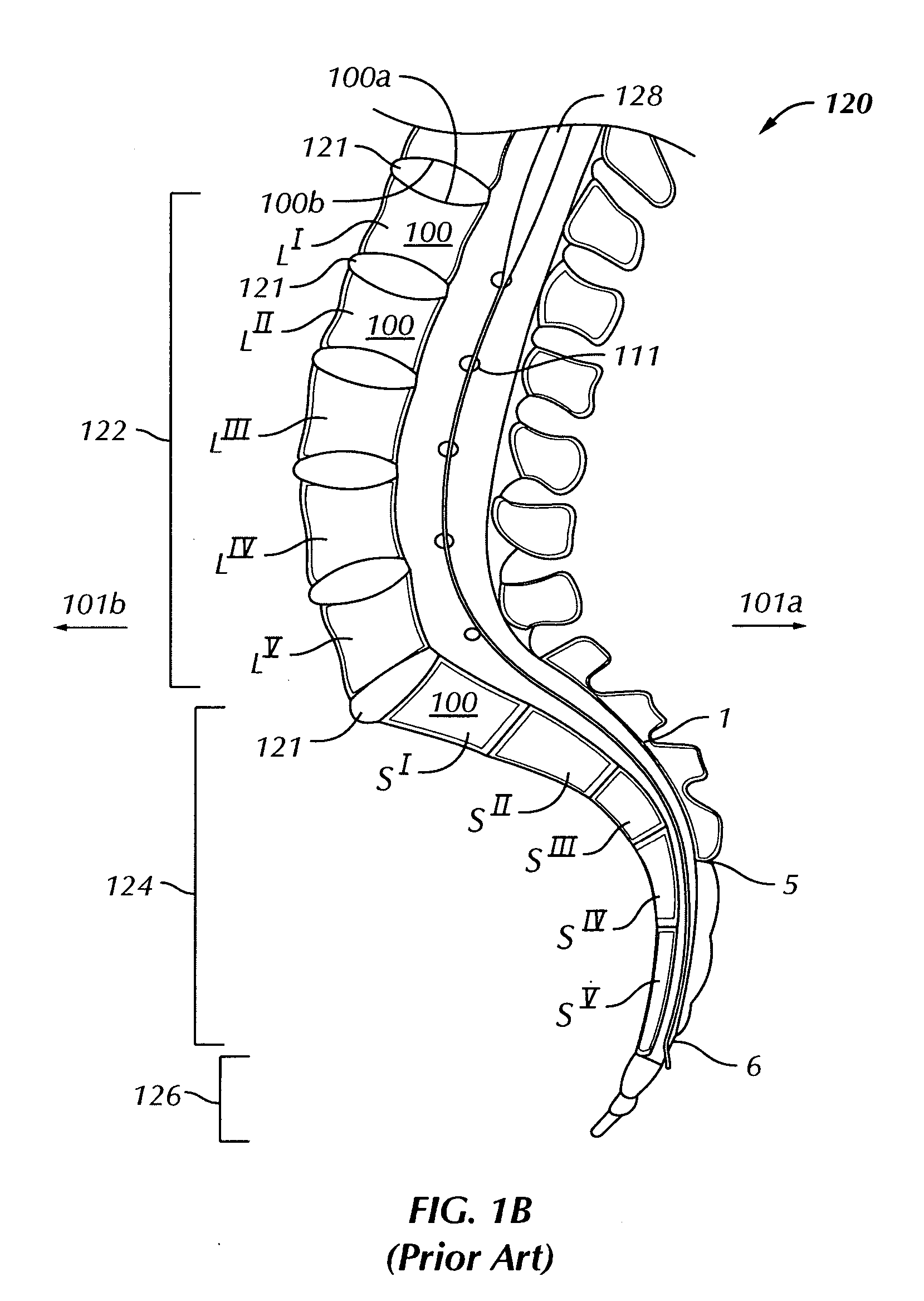 Internal fixation system for spine surgery
