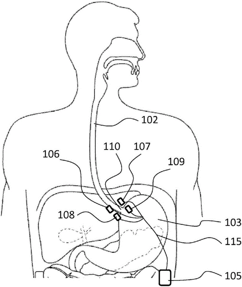 Methods and systems of electrode polarity switching in electrical stimulation therapy