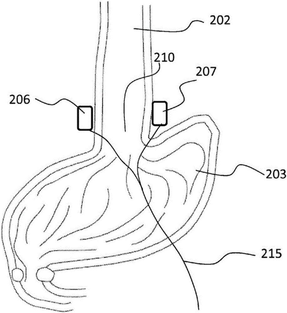 Methods and systems of electrode polarity switching in electrical stimulation therapy
