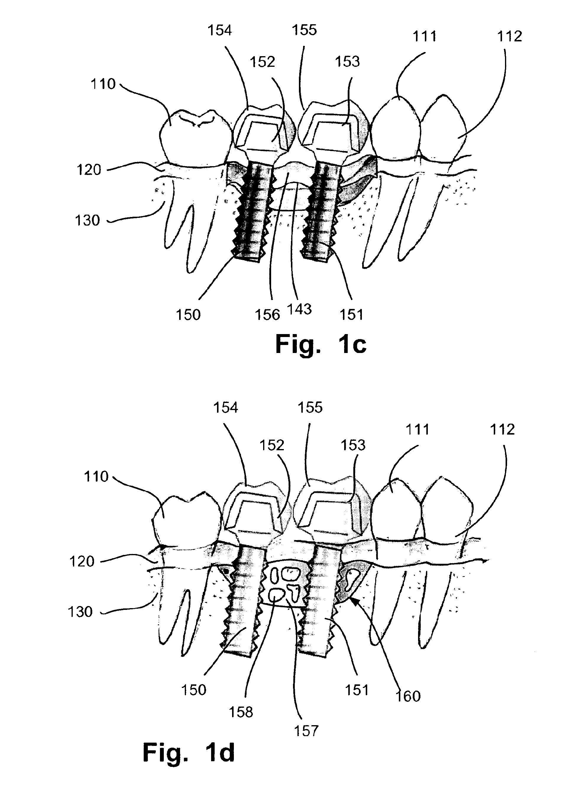 Computer implemented planning and providing of mass customized bone structure