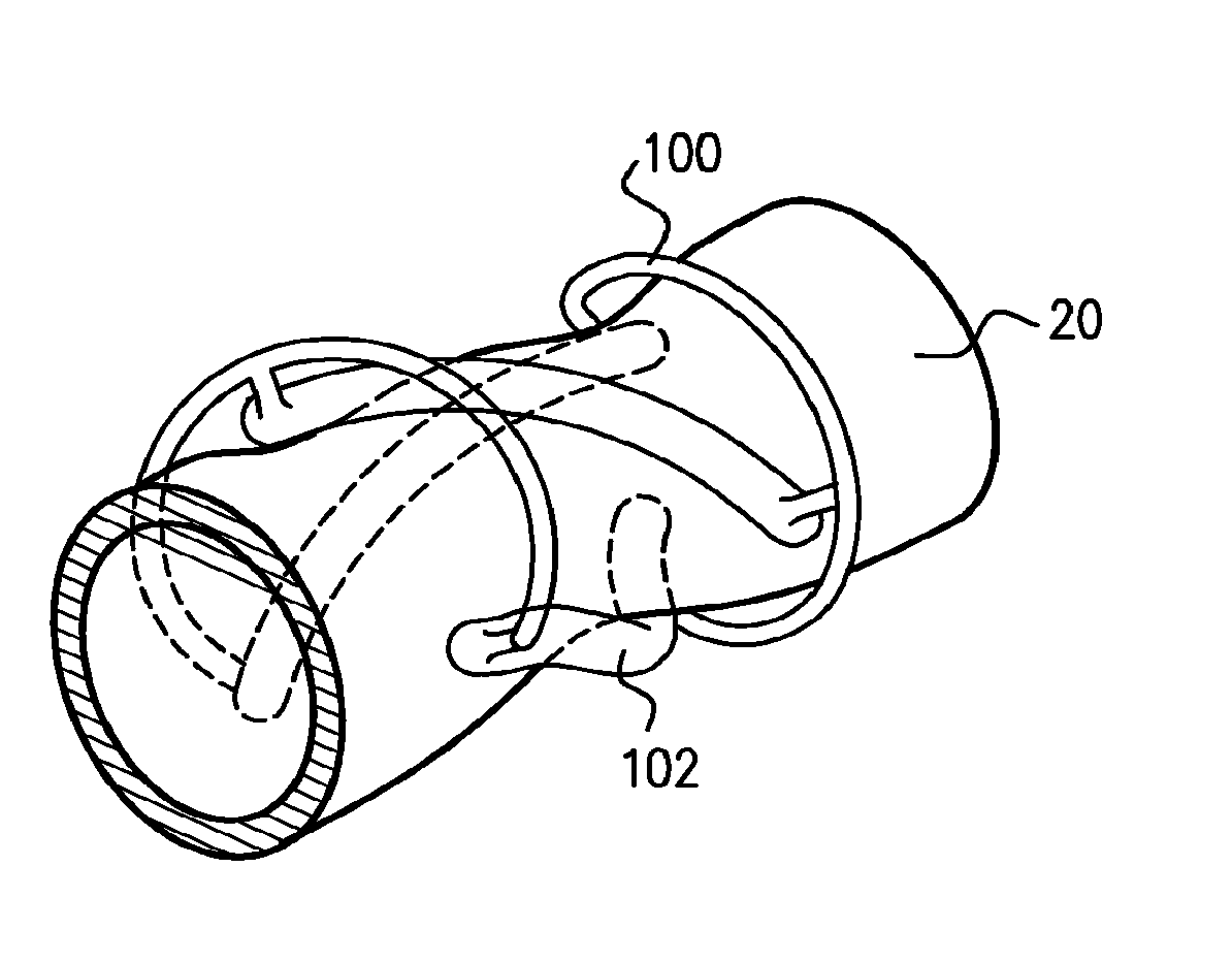Devices and Methods for Control of Blood Pressure