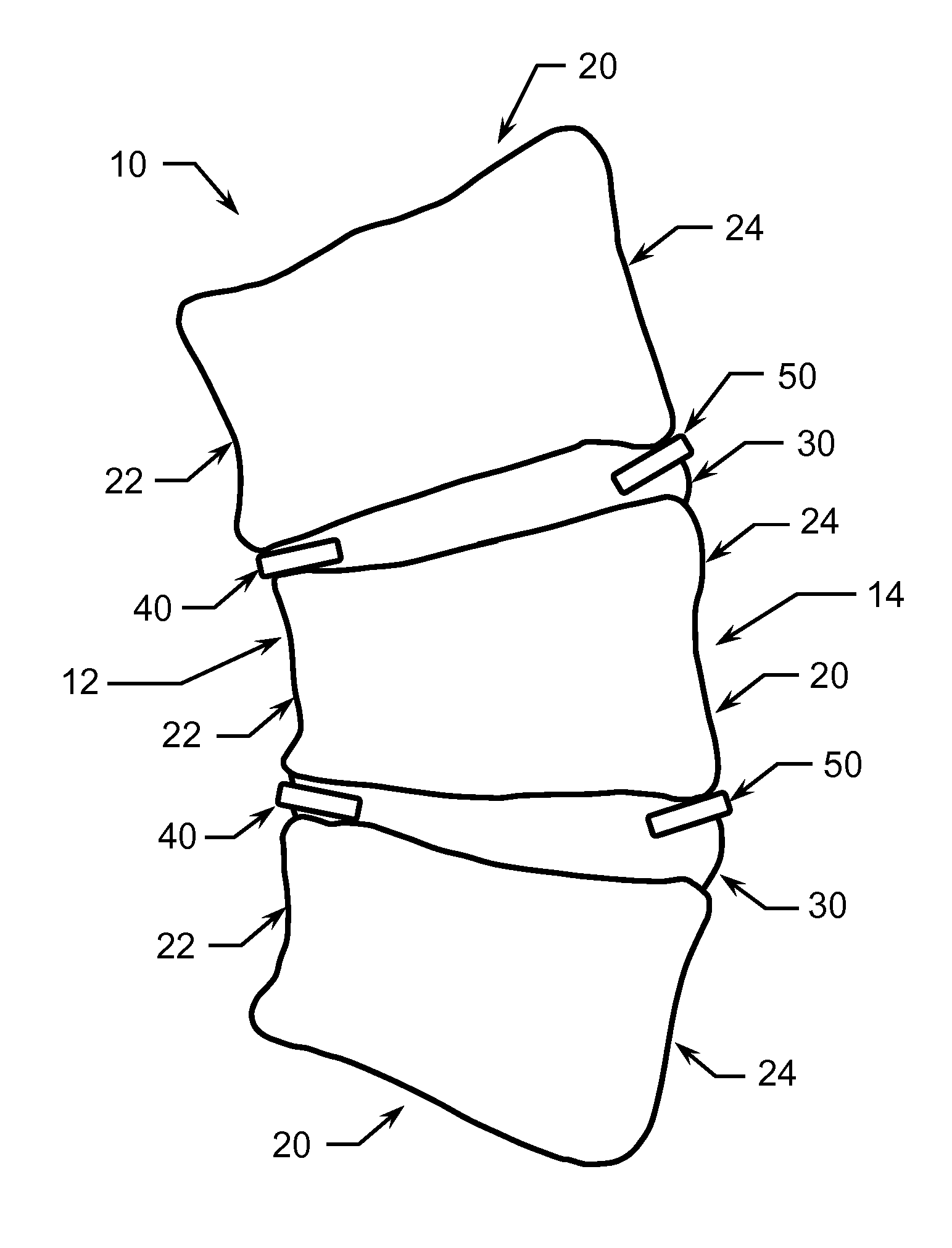 Method of treating scoliosis using a biological implant