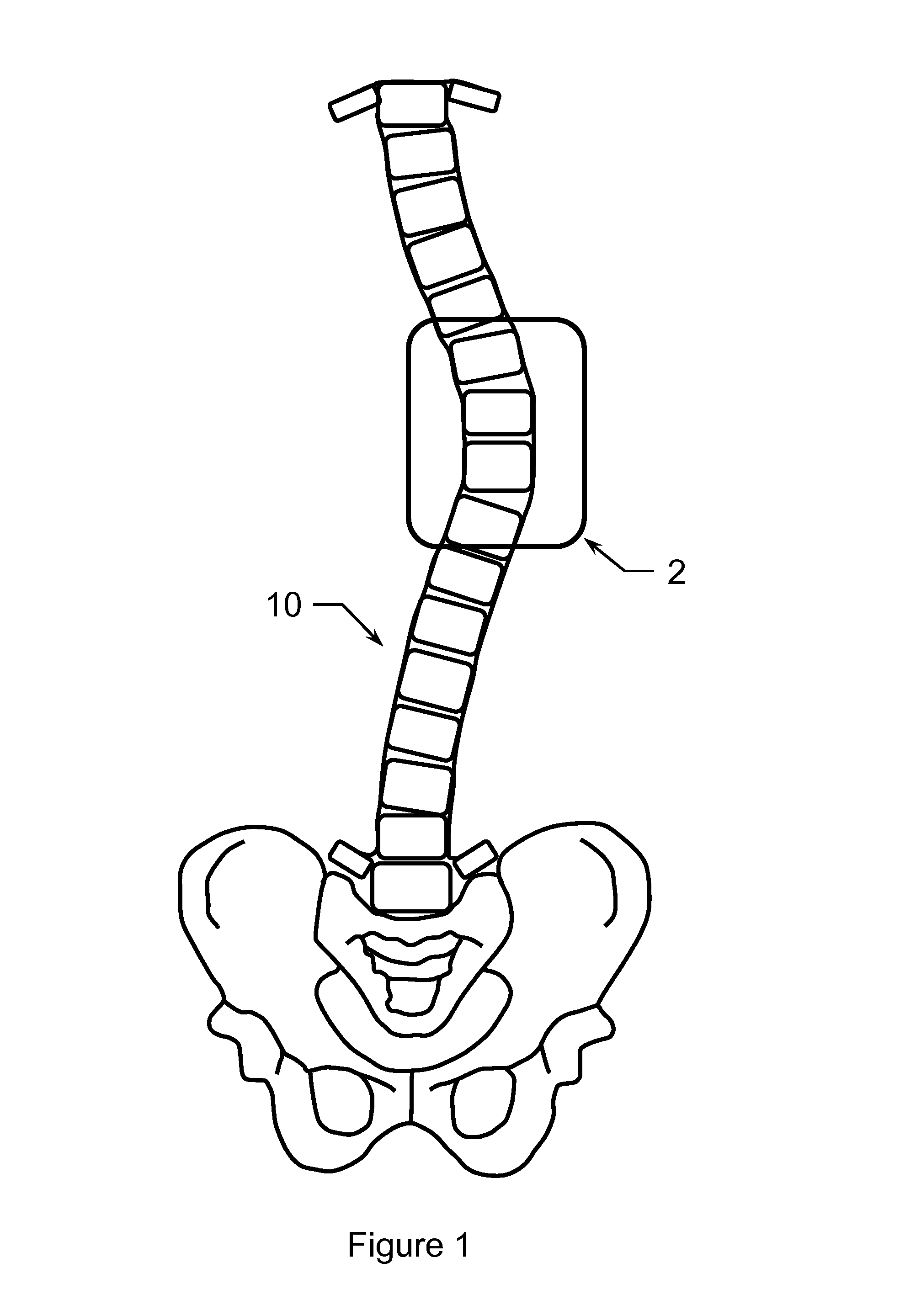 Method of treating scoliosis using a biological implant