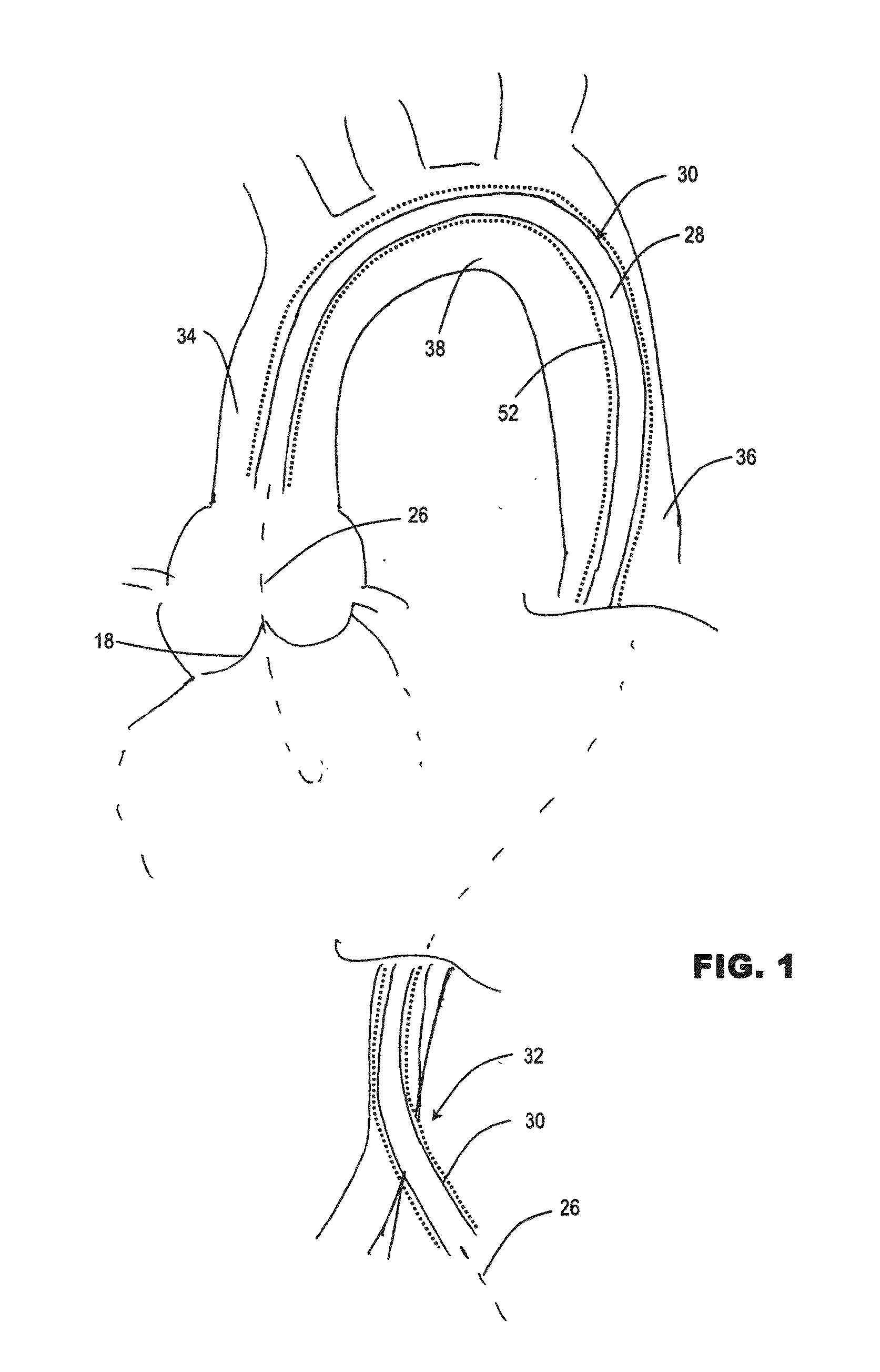 Method and Apparatus Useful for Transcatheter Aortic Valve Implantation