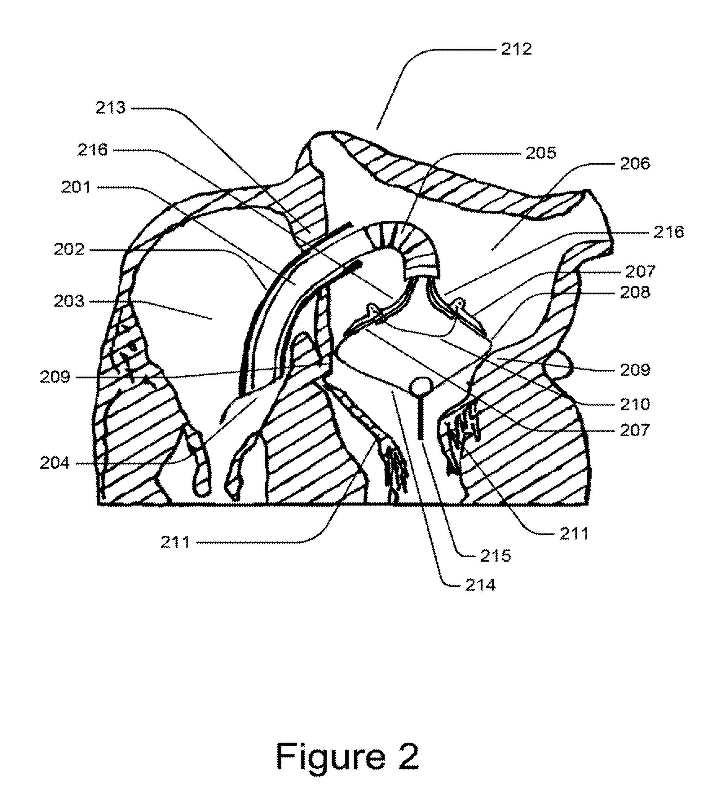 Medical device for constricting tissue or a bodily orifice, for example a mitral valve