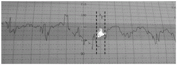 Fetal heart rate curve correction method and device