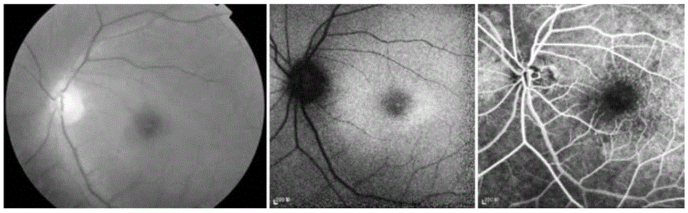 Pathogenic mutant gene of hereditary central areolar retinopathy and detection reagent thereof