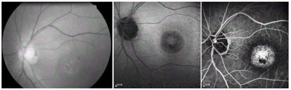 Pathogenic mutant gene of hereditary central areolar retinopathy and detection reagent thereof