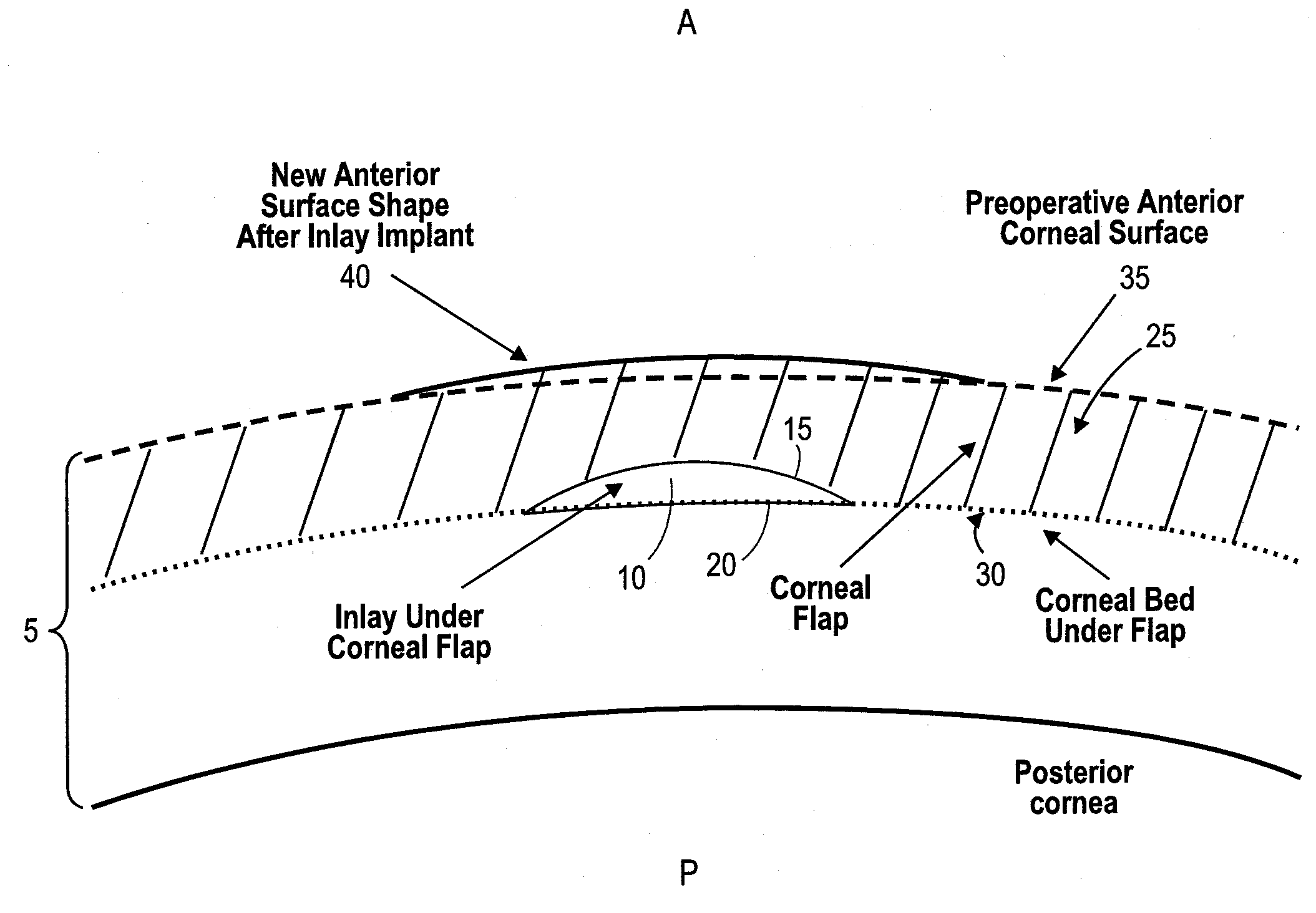 Corneal Inlay Design and Methods of Correcting Vision