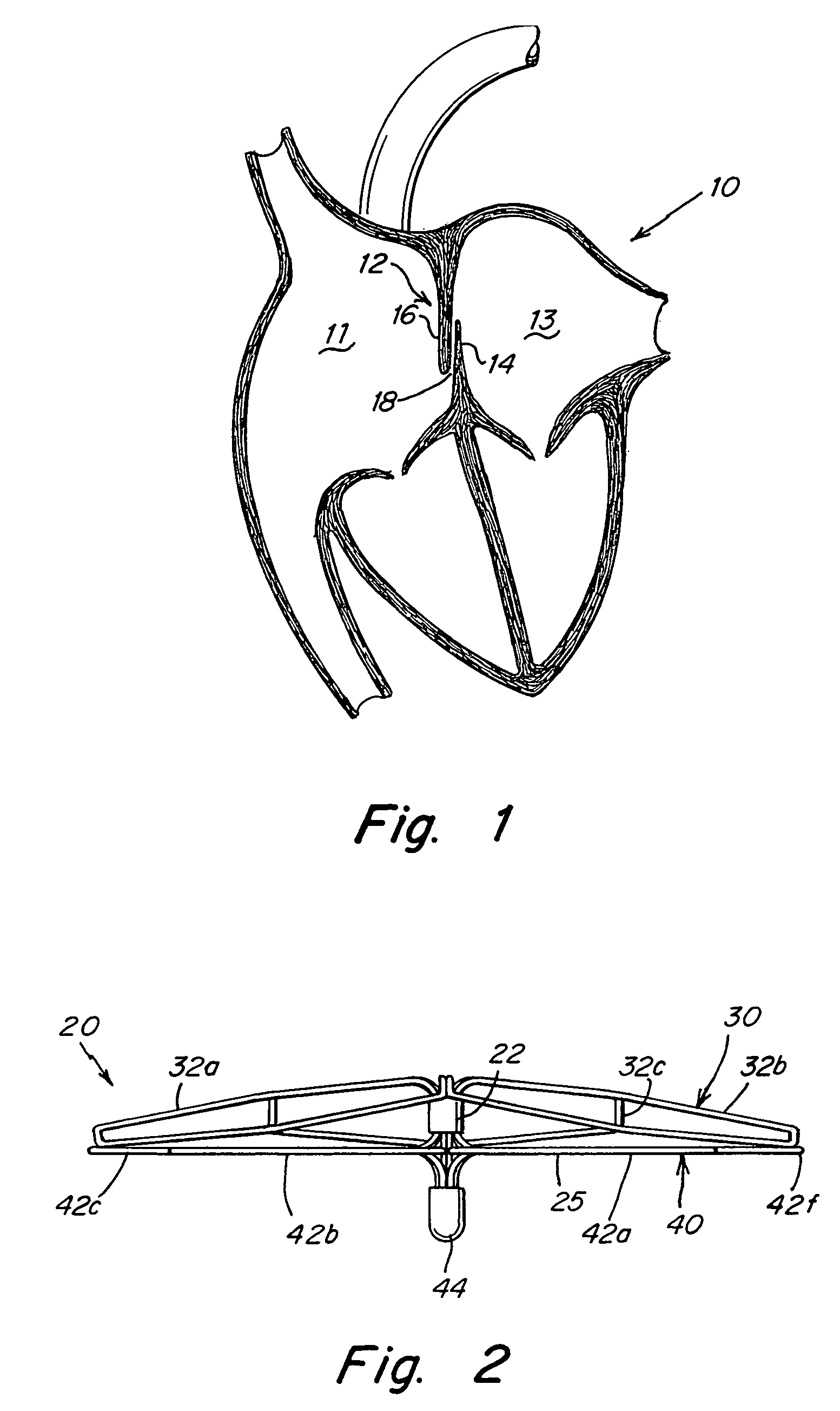 Patent foramen ovale (PFO) closure device with radial and circumferential support
