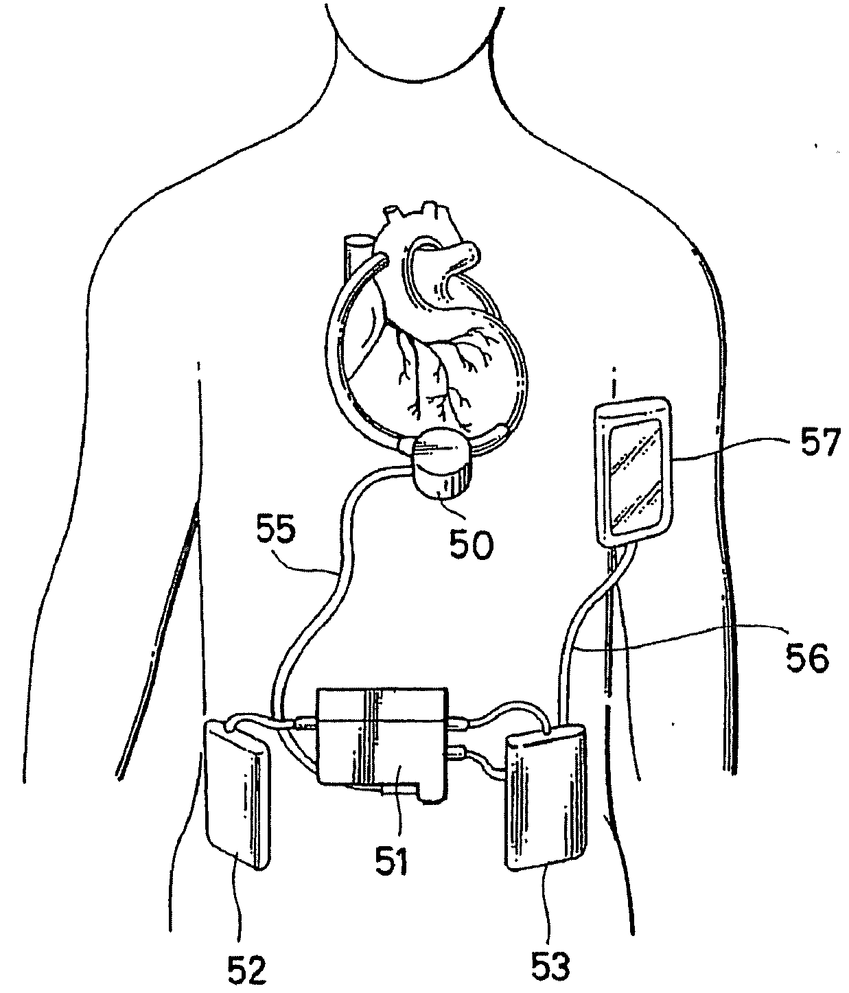 Artificial heart pump system and its control apparatus