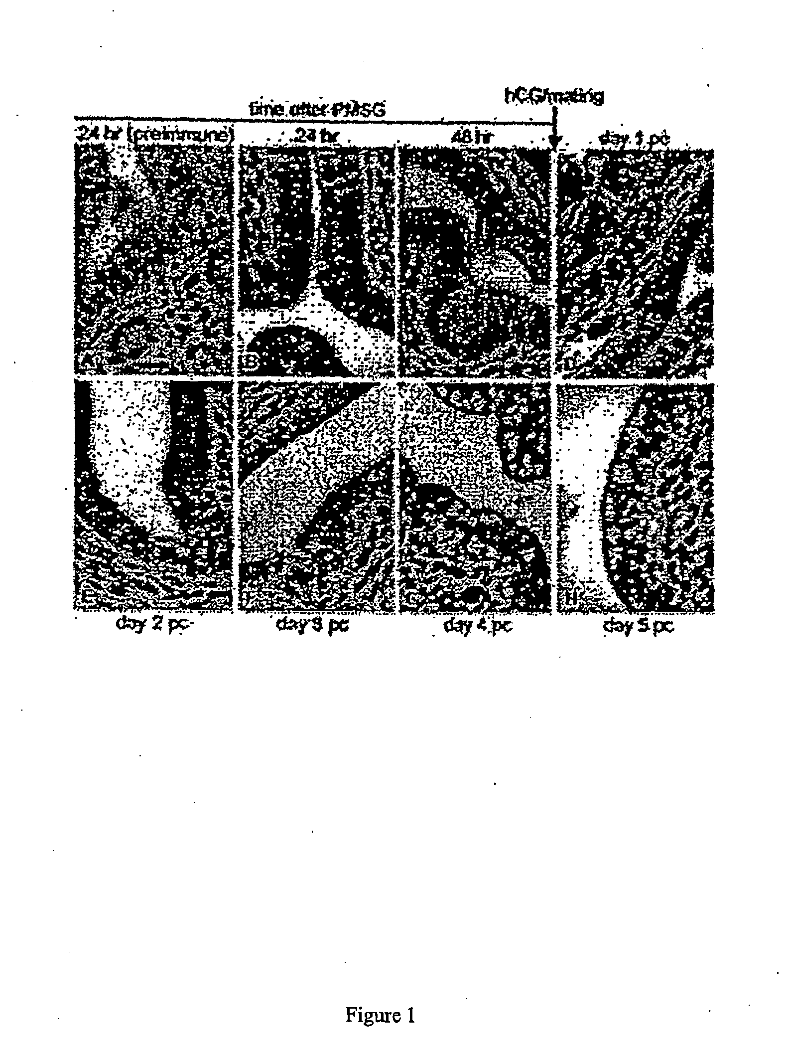 Methods for Diagnosis and Treatment of Endometrial Cancer