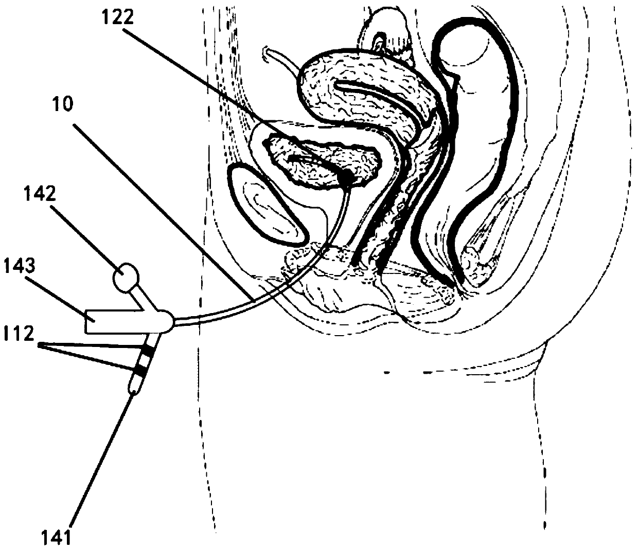 Intravesical catheter integrated with stimulating electrode