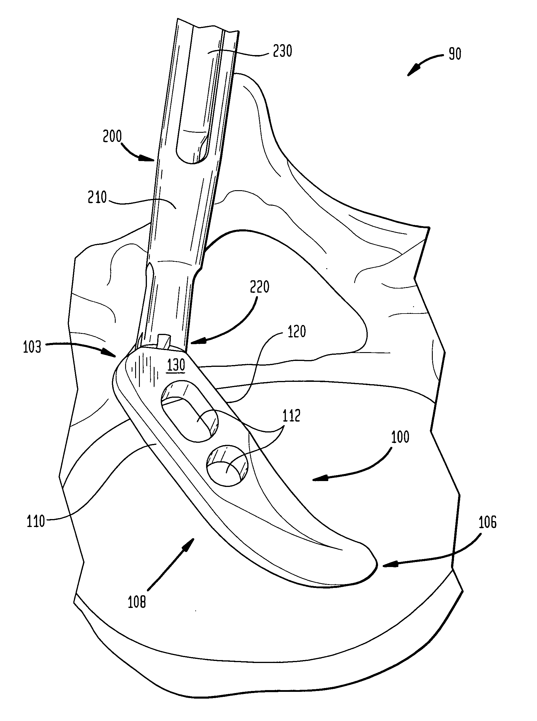 Spinal implant apparatus and methods