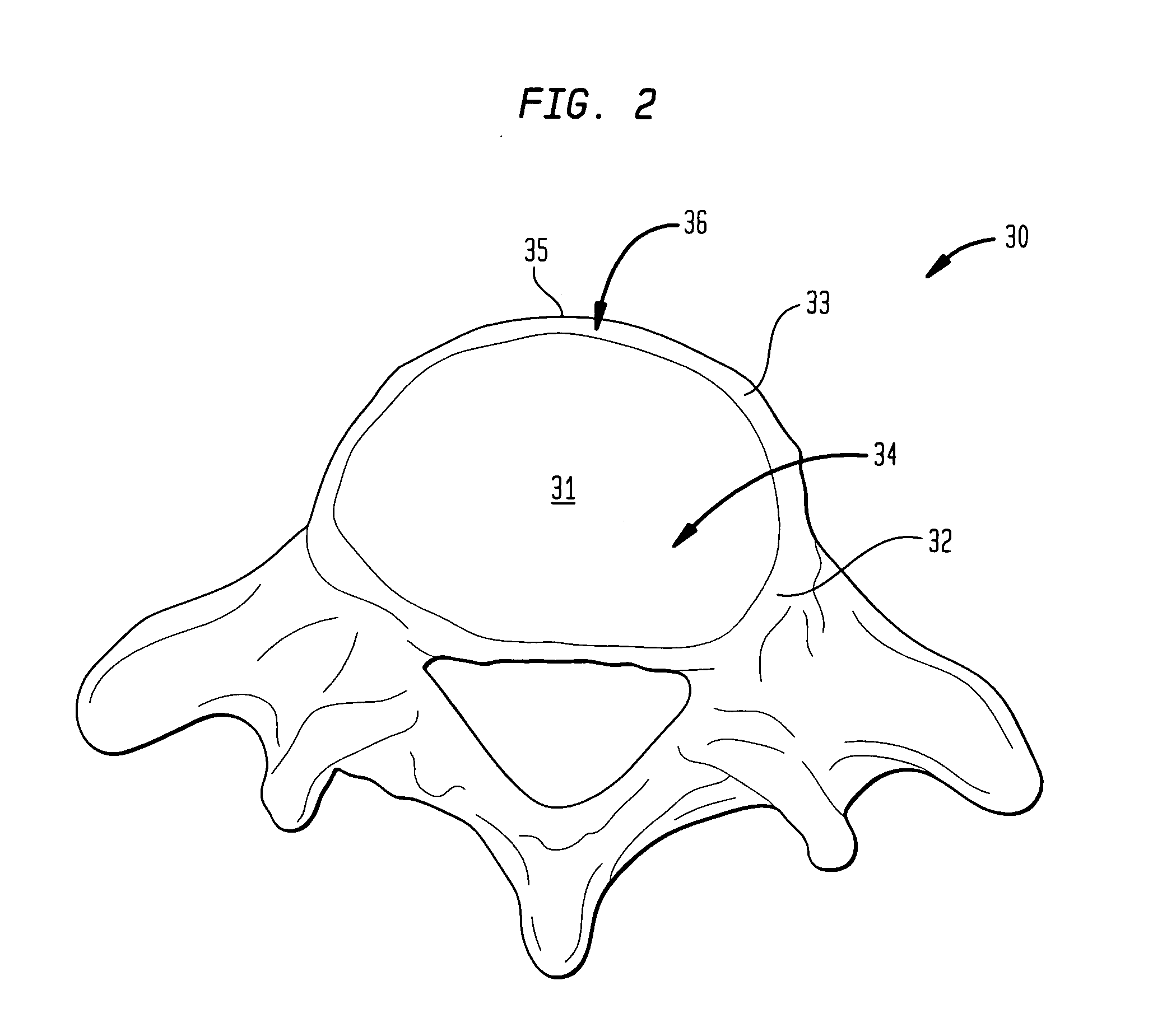 Spinal implant apparatus and methods