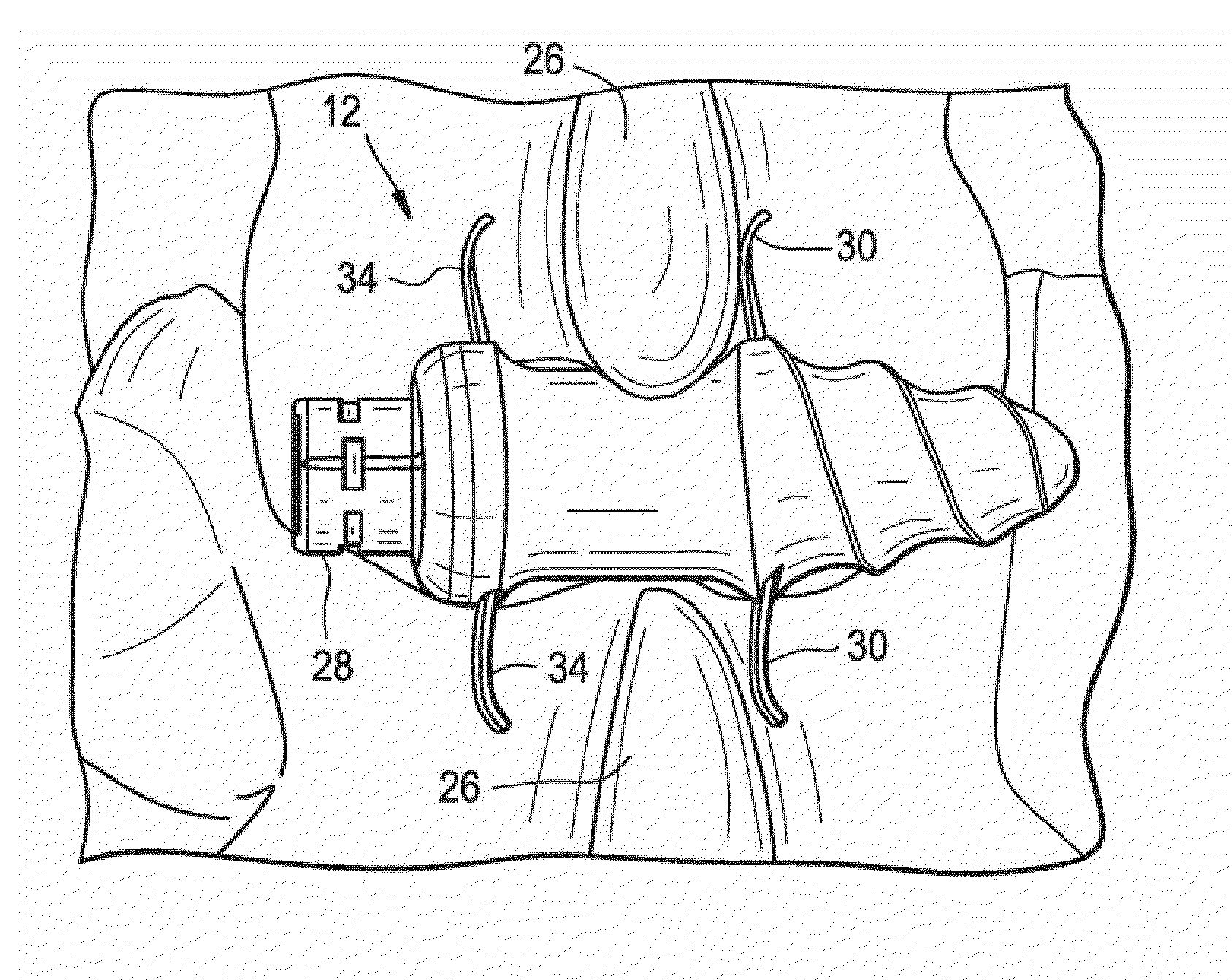 Conical interspinous apparatus and a method of performing interspinous distraction