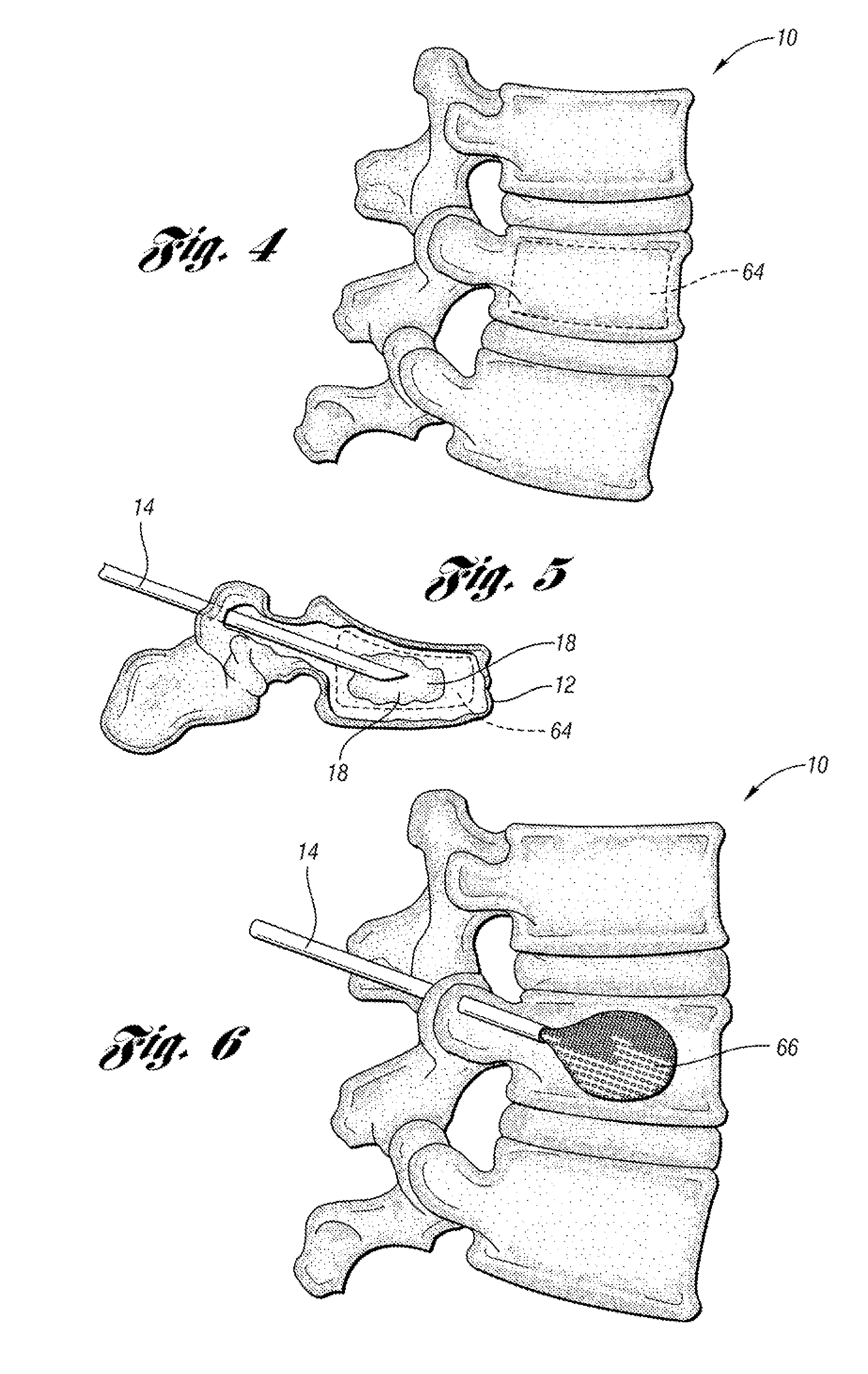 Bone cement mixing and delivery device and method of use