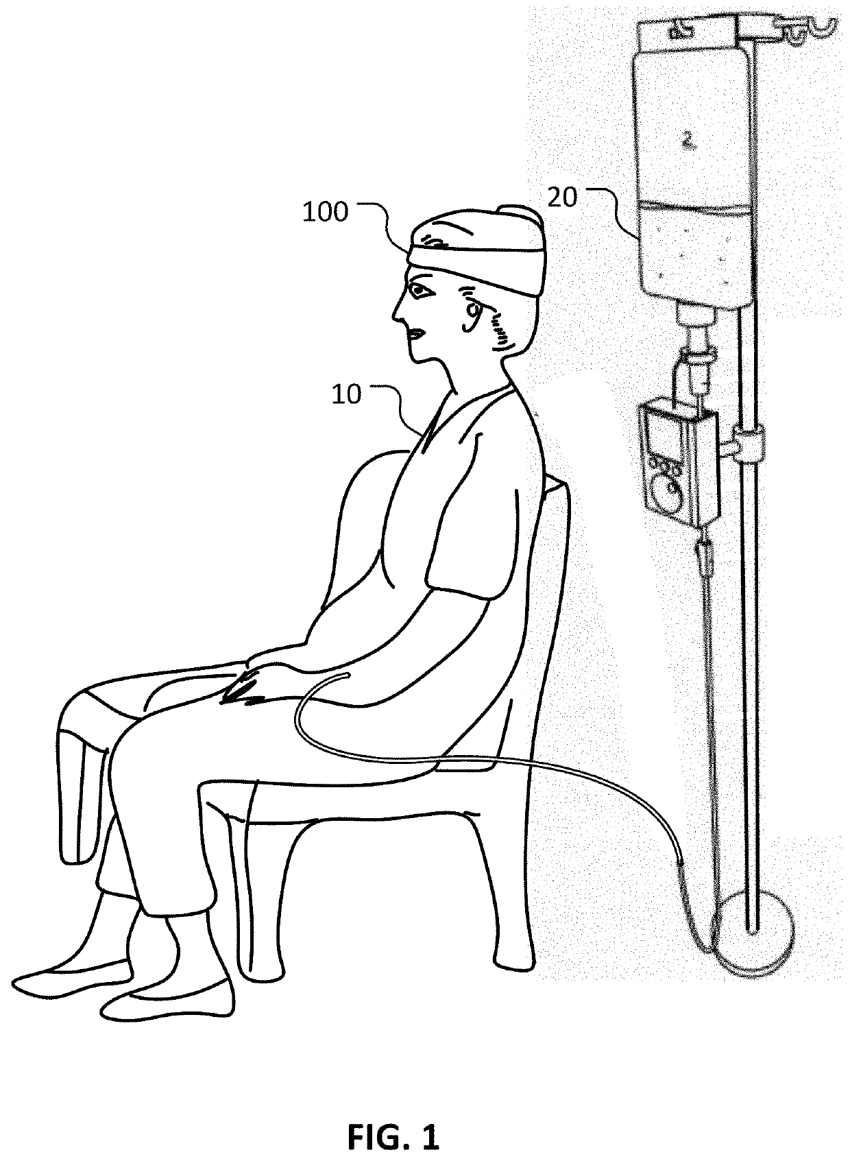 Physical obstruction of scalp arterial circulation to prevent chemotherapy associated alopecia