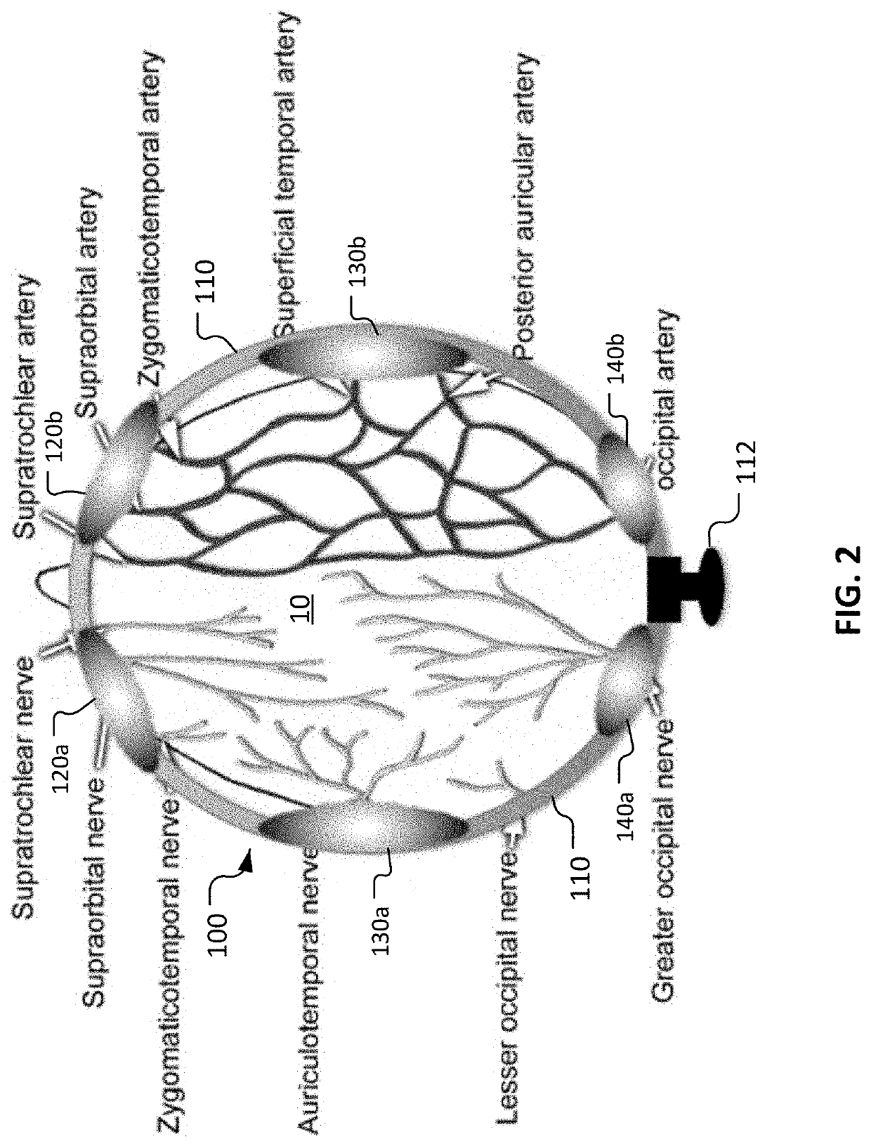 Physical obstruction of scalp arterial circulation to prevent chemotherapy associated alopecia