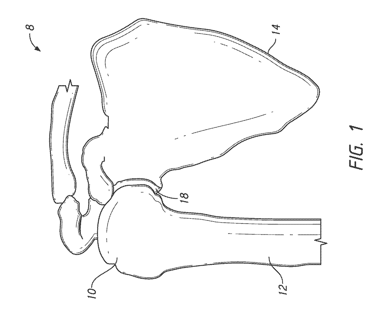 Guides and instruments for improving accuracy of glenoid implant placement