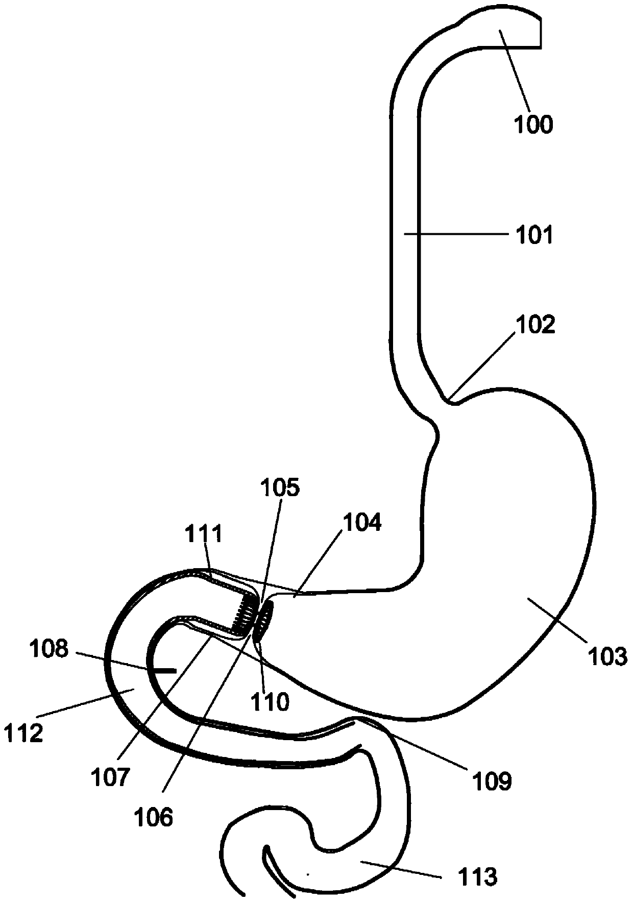 Anchors and methods for intestinal bypass sleeves