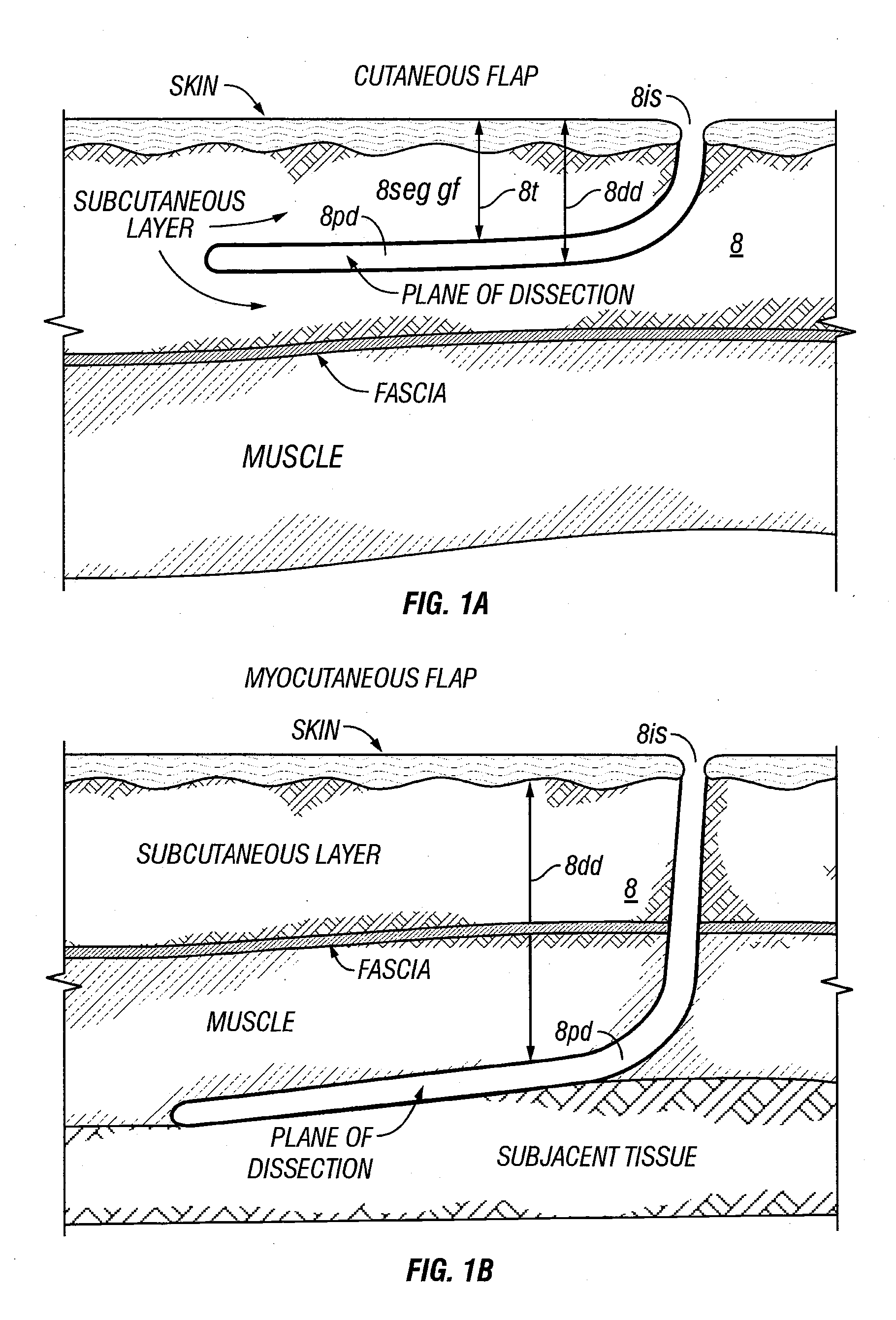 Method and apparatus for surgical dissection
