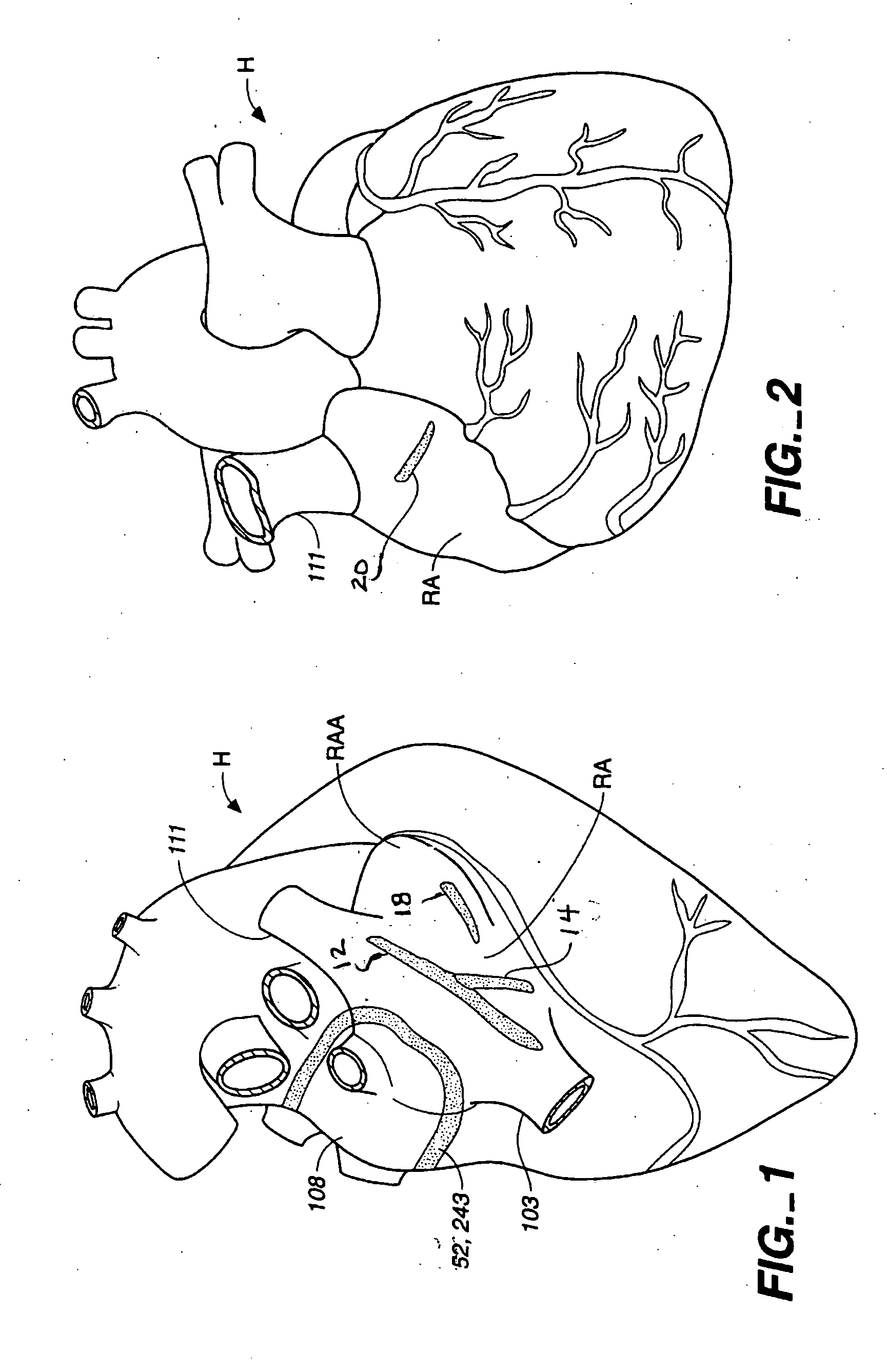 System and methods for treating atrial fibrillation using electroporation