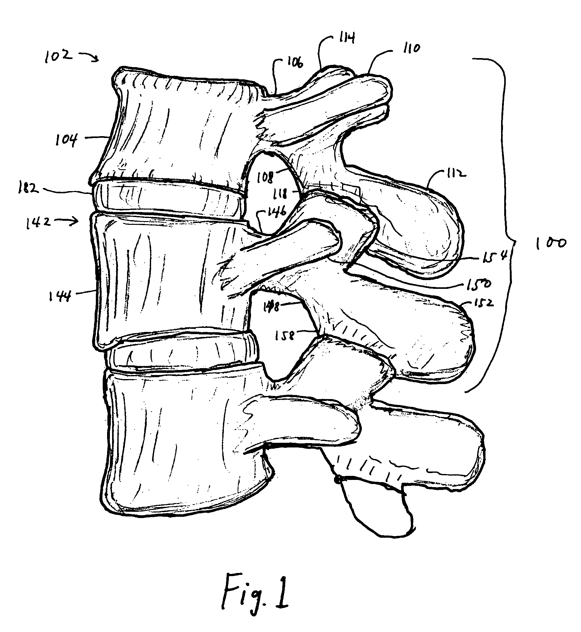 Facet joint prosthesis