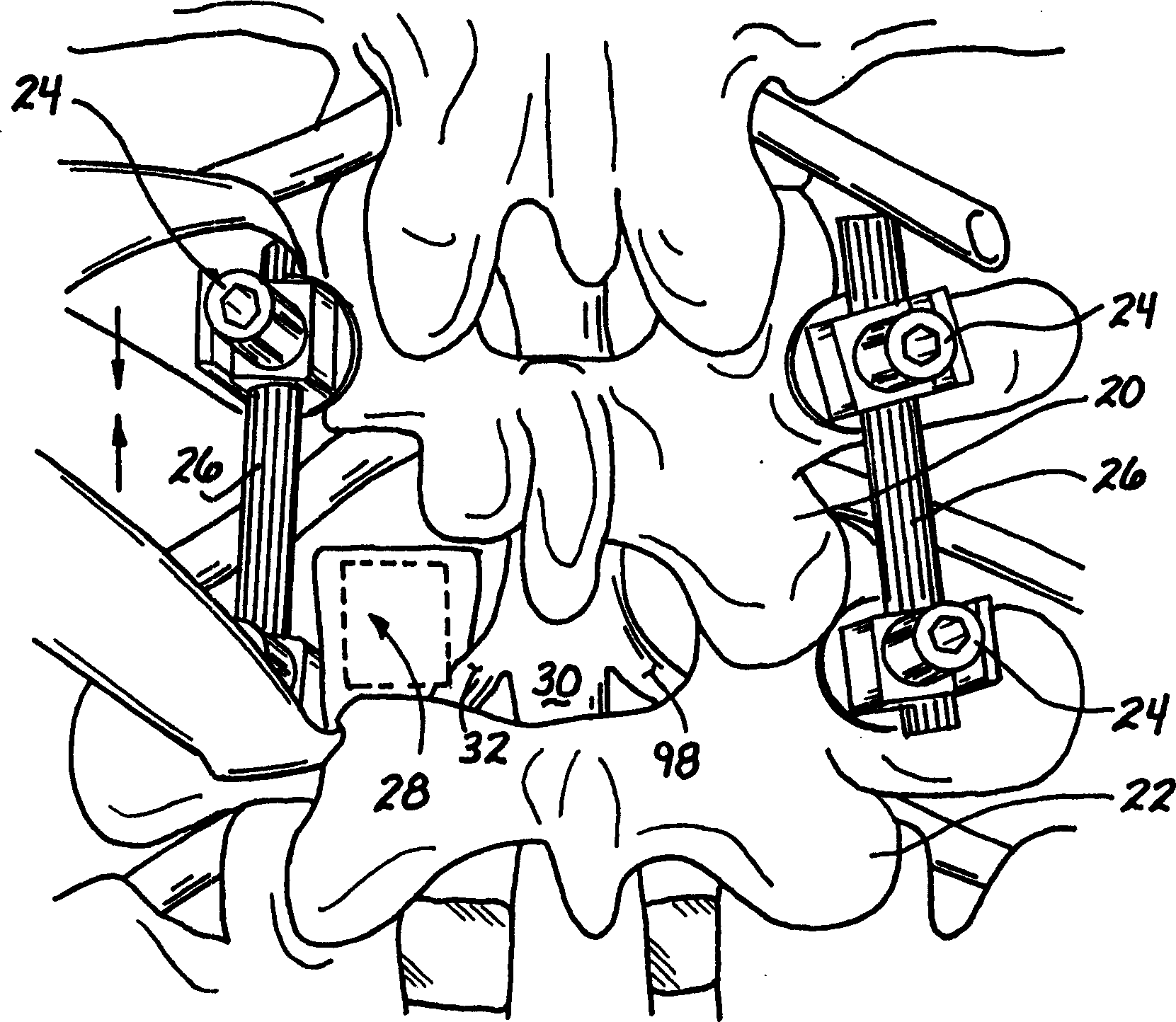 Resorbable micro-membrane for attenuation of scar tissue