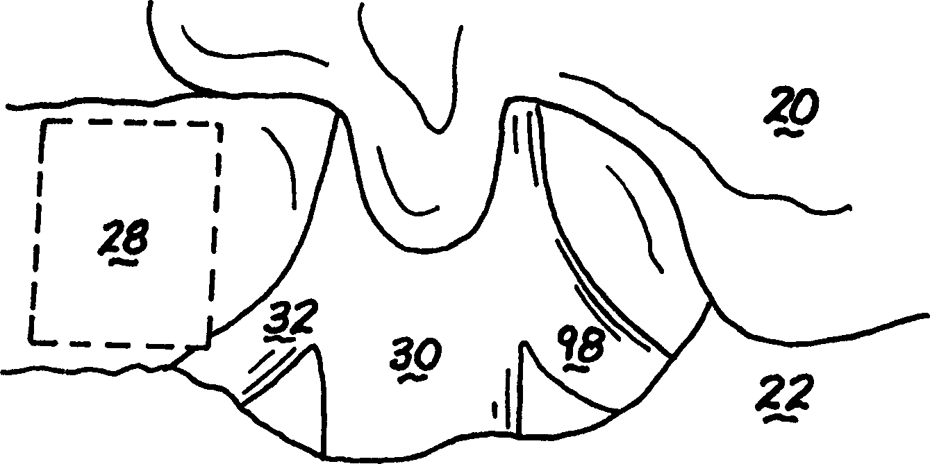 Resorbable micro-membrane for attenuation of scar tissue