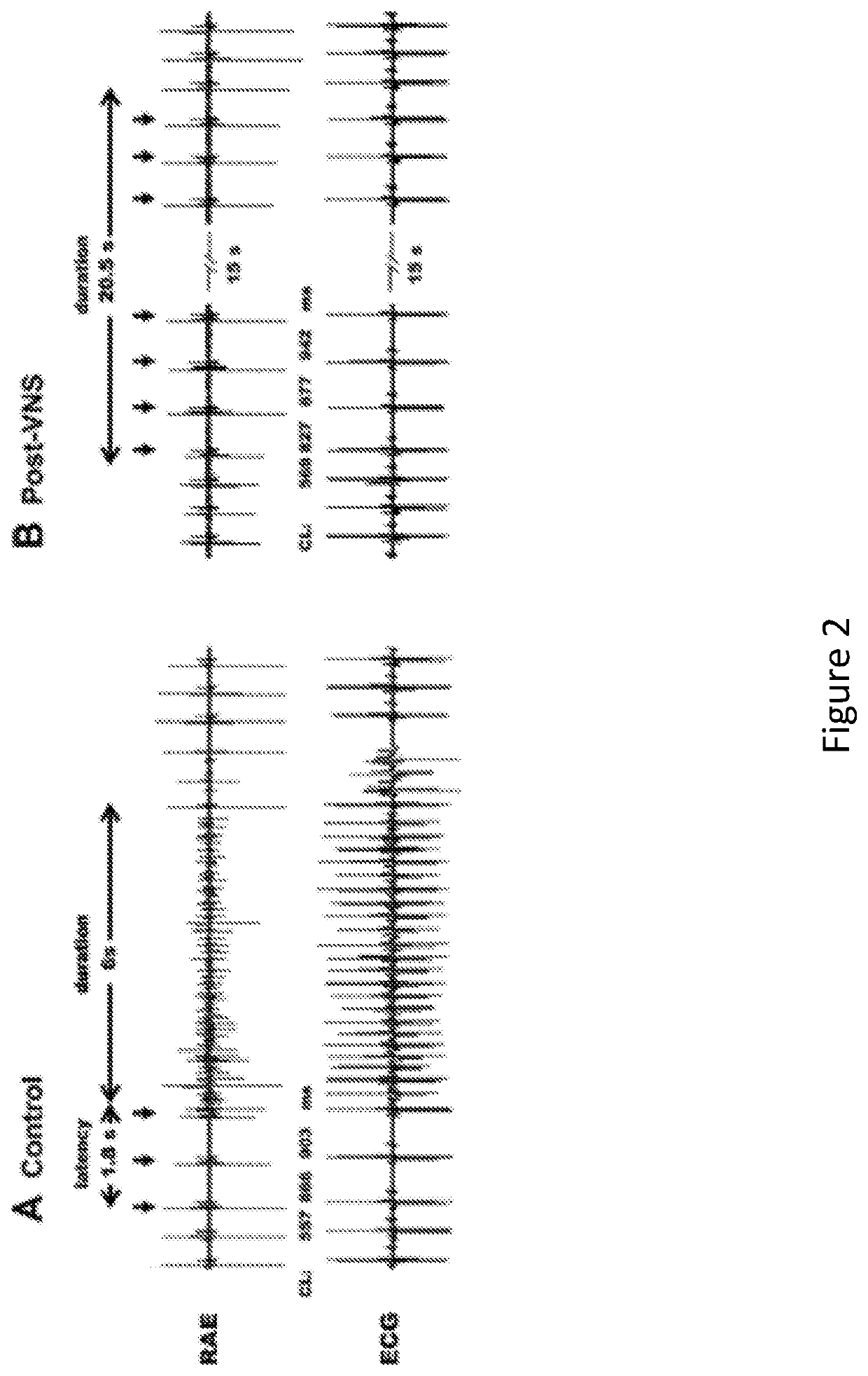 Monitoring and modulation of parasympathetic nervous system