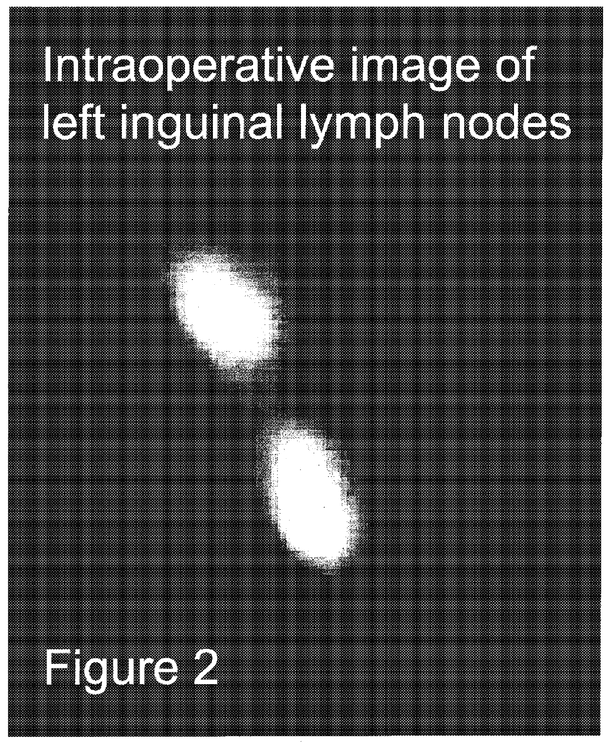 Pre-and-intra-operative localization of penile sentinel nodes