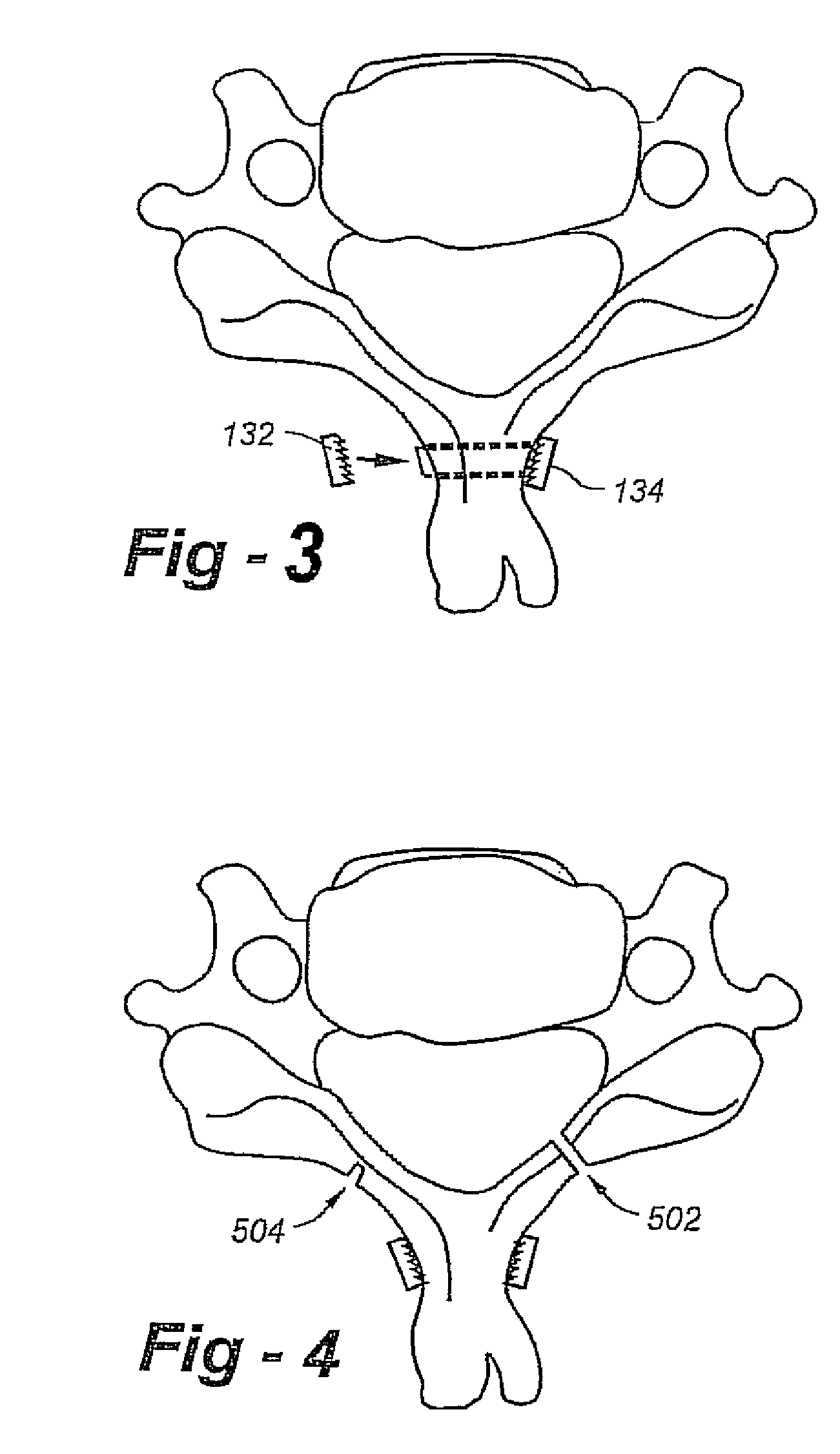 Laminoplasty apparatus and methods