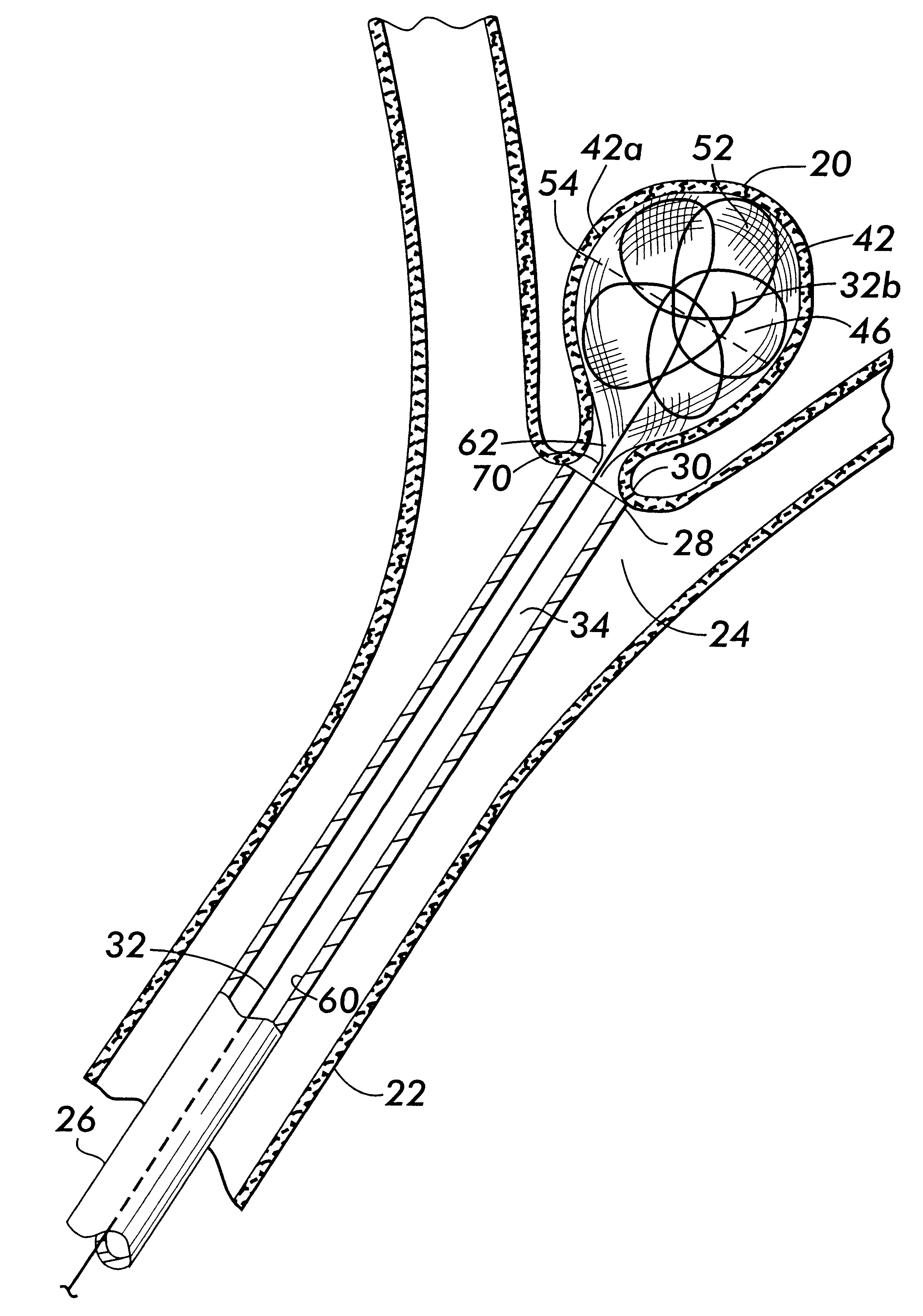 Bag for use in the intravascular treatment of saccular aneurysms