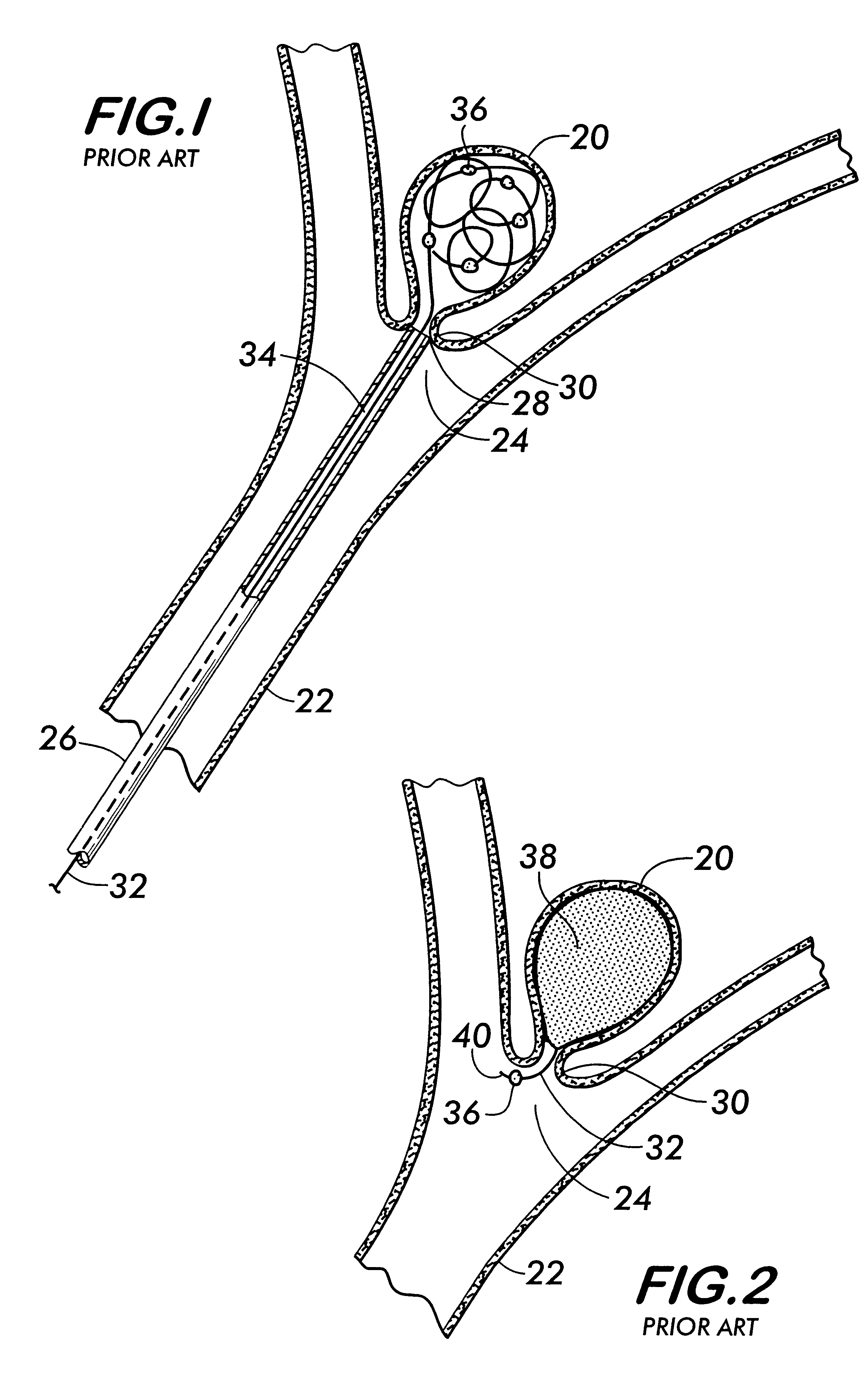 Bag for use in the intravascular treatment of saccular aneurysms
