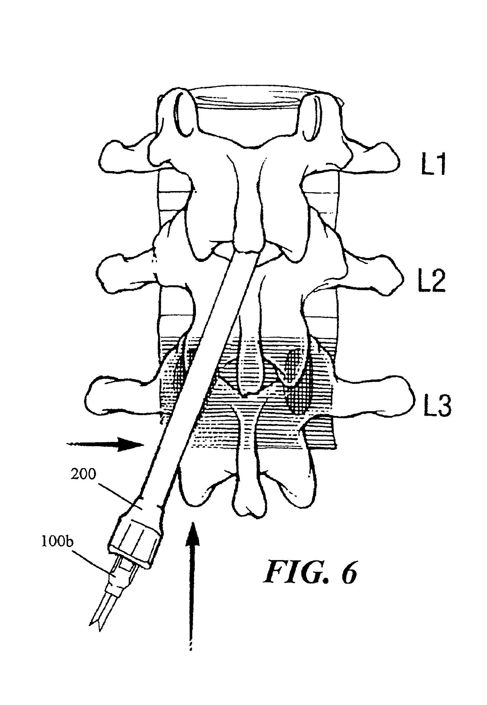 Stimulation/sensing lead adapted for percutaneous insertion