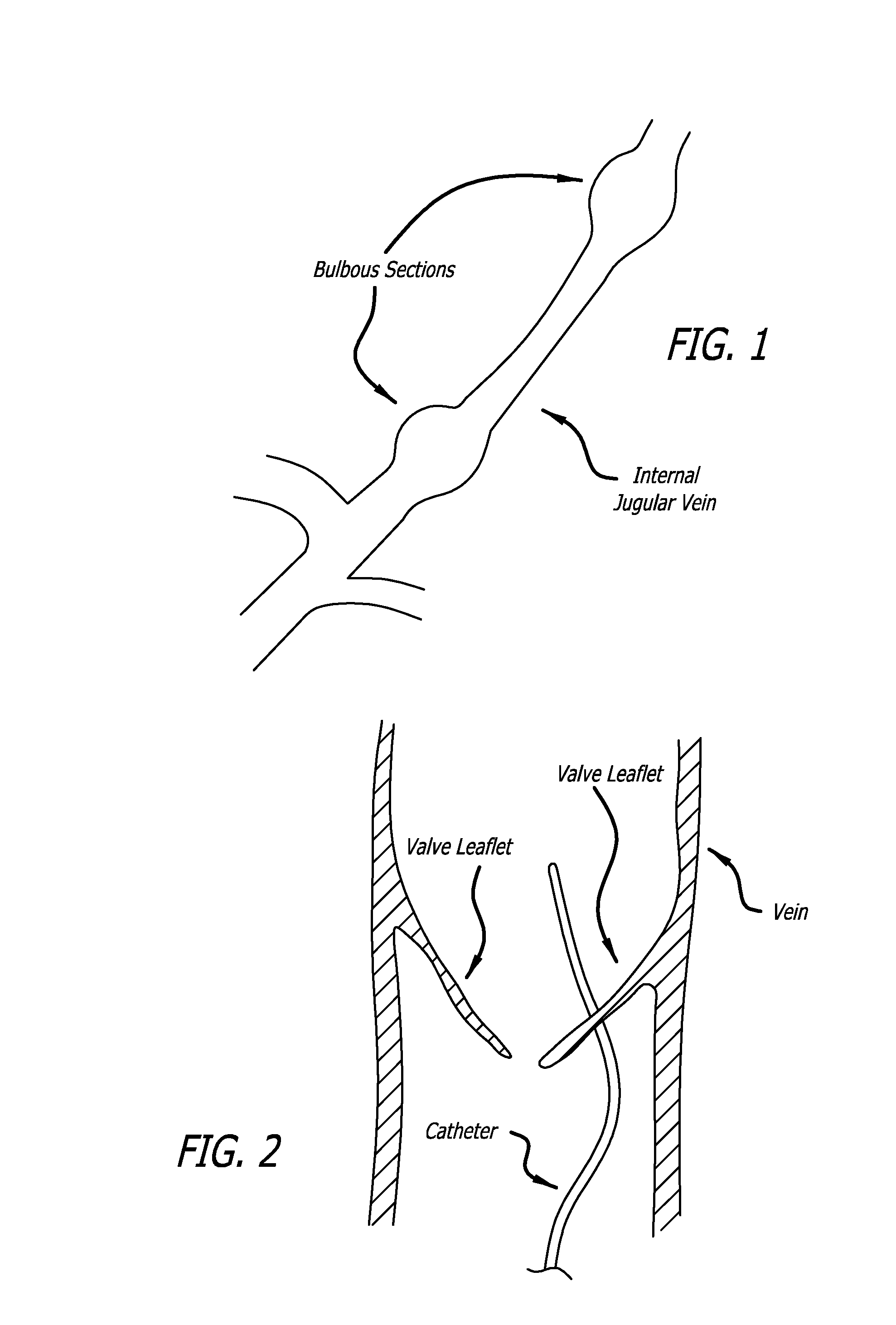 Methods of treating a condition of a vessel in a patient