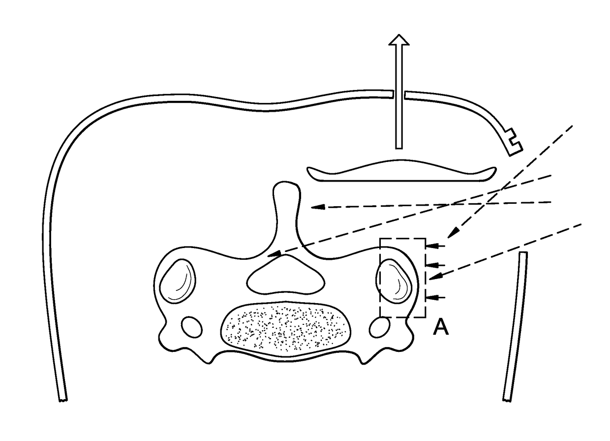 Method and devices for a sub-splenius / supra-levator scapulae surgical access technique