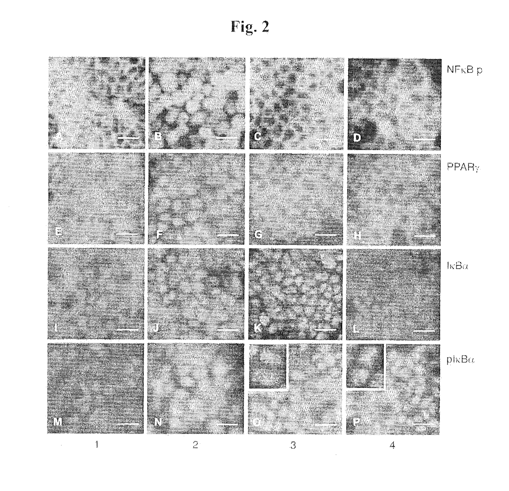 Methods for treating an inflammatory disease of the bowel